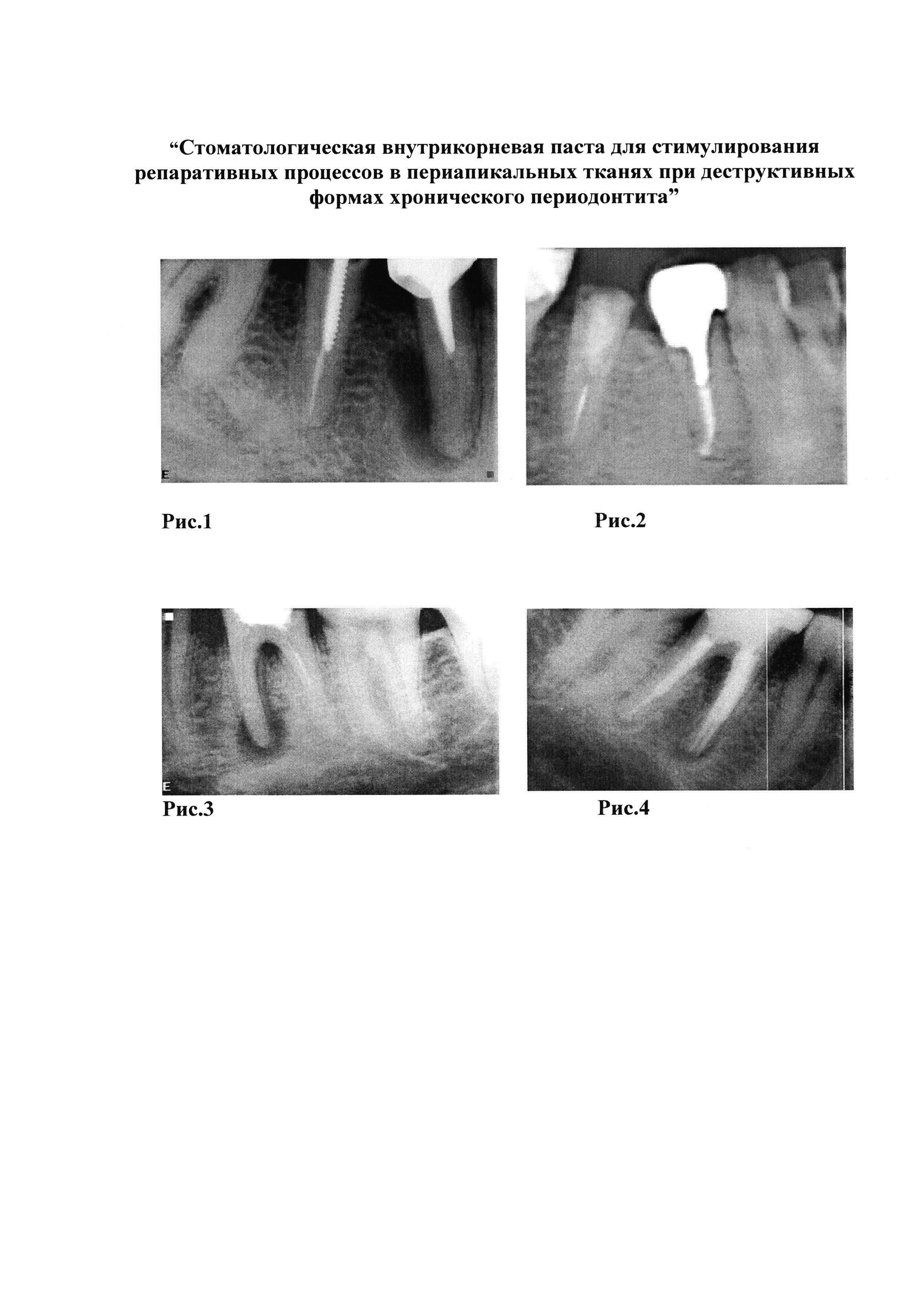 Стоматологическая внутрикорневая паста для стимулирования репаративных процессов в периапикальных тканях при деструктивных формах хронического периодонтита