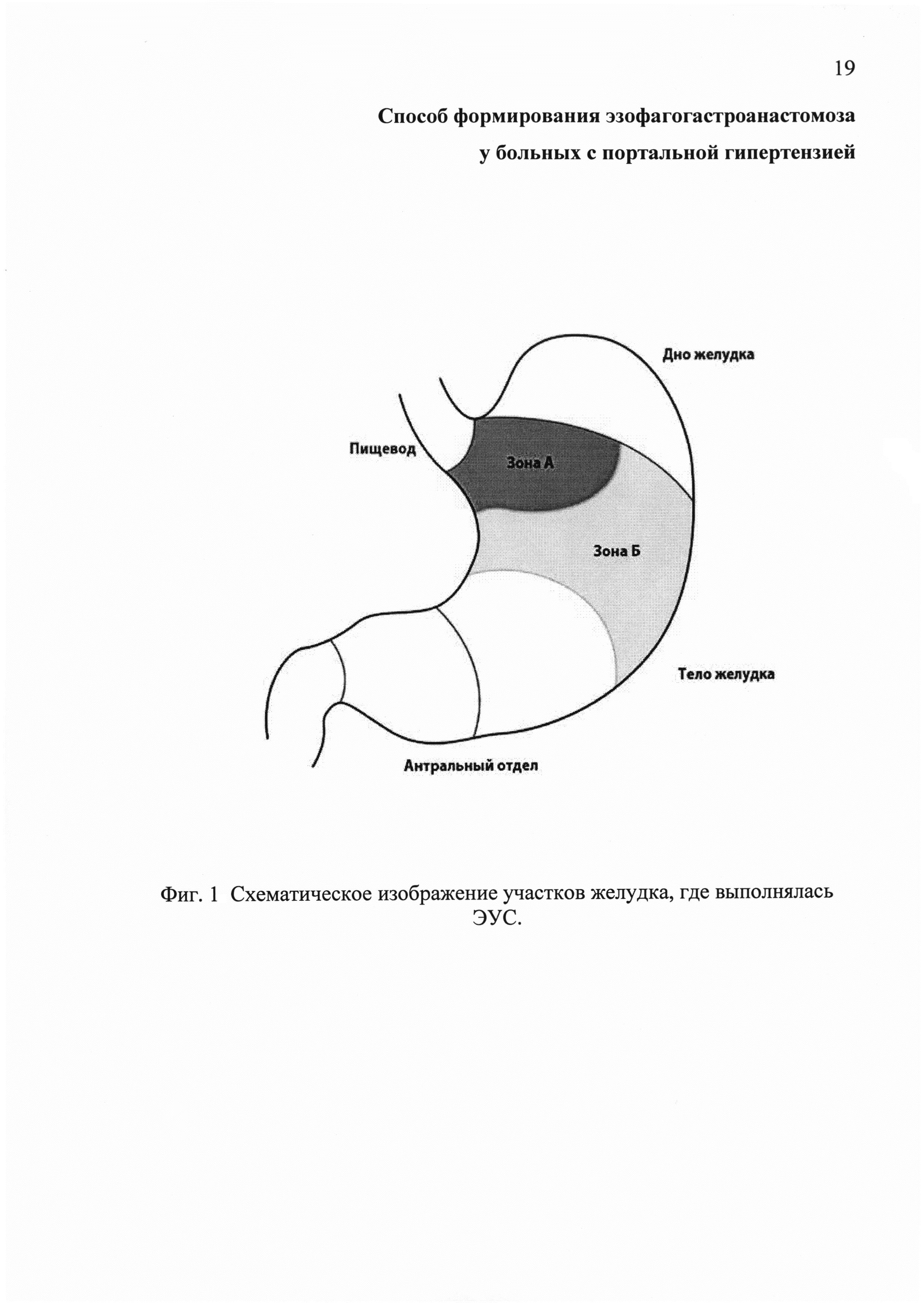 Способ формирования эзофагогастроанастомоза у больных с портальной гипертензией