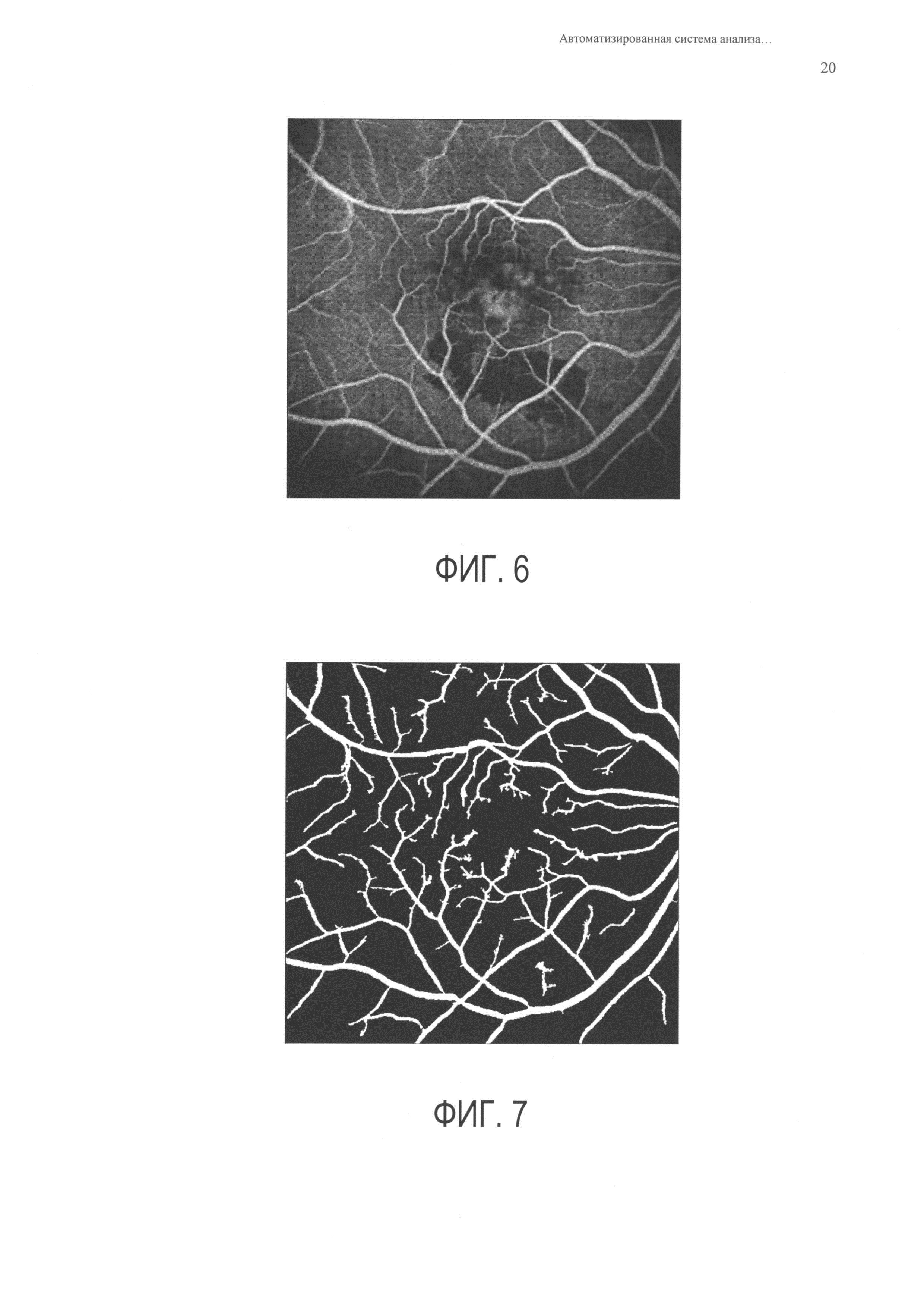 Автоматизированная система анализа ангиографических изображений глазного дна человека