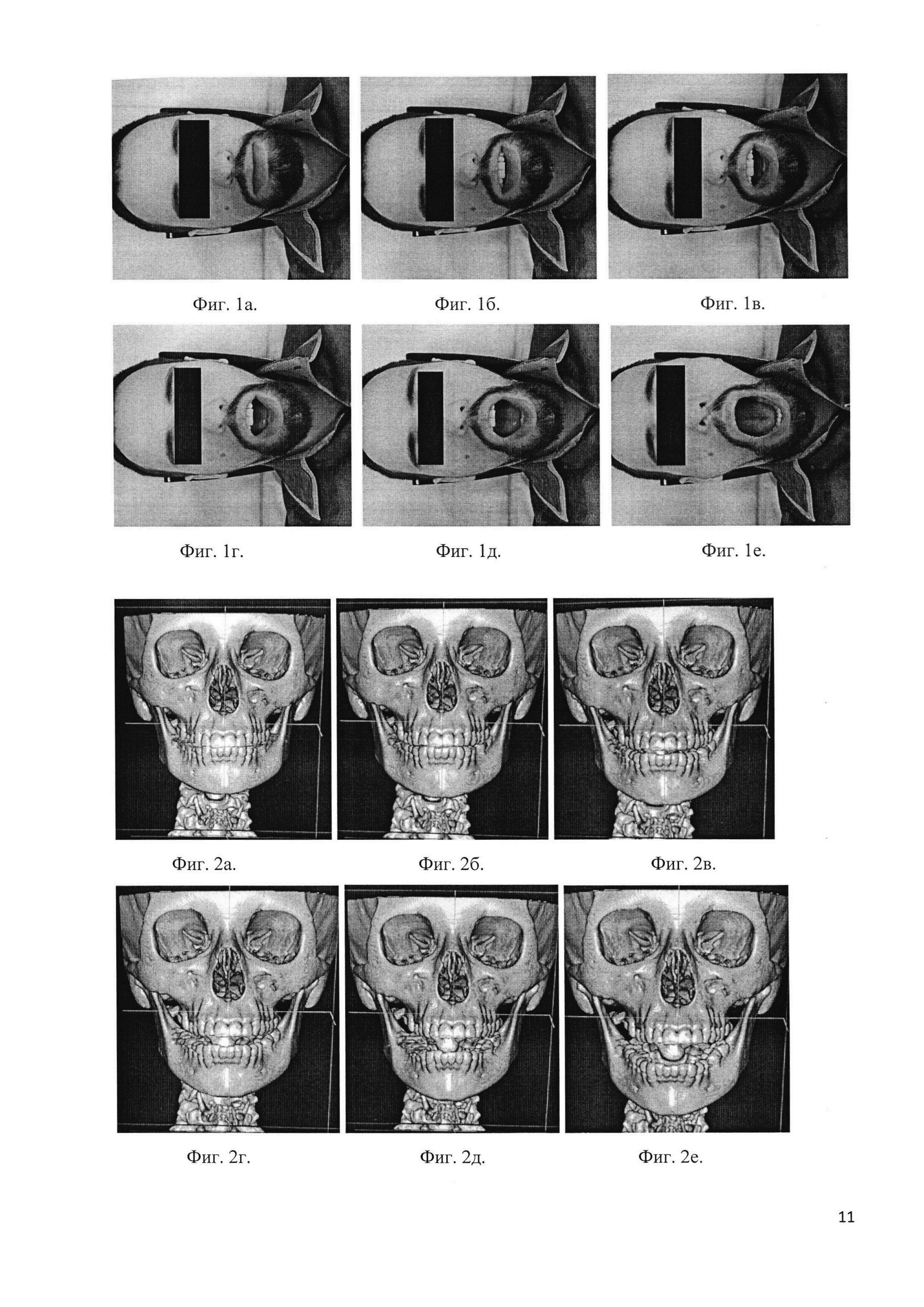 Способ функциональной мультиспиральной компьютерно-томографической диагностики дисфункции височно-нижнечелюстных суставов