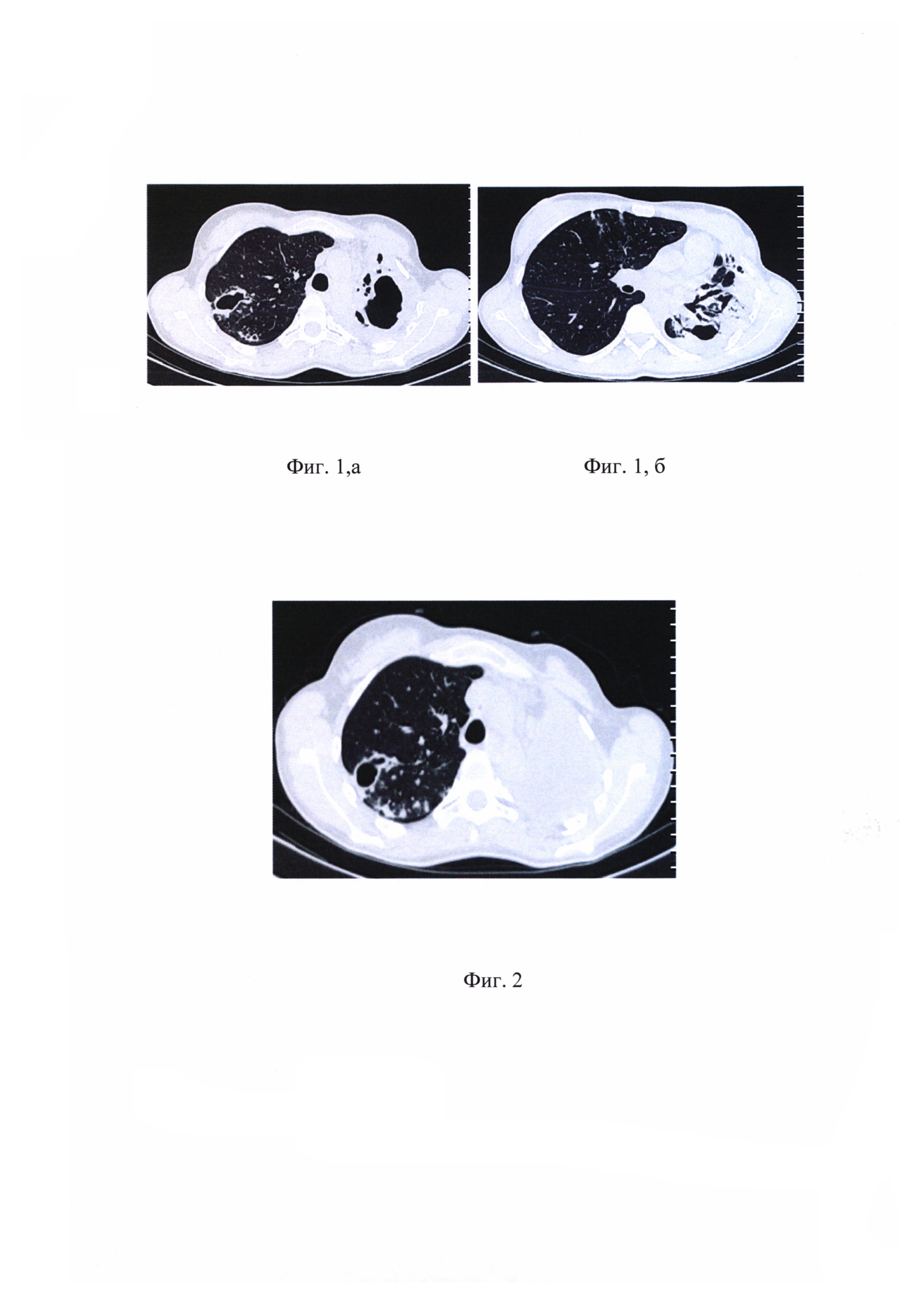 Способ экстраплеврального пневмолиза при лечении распространённого фиброзно-кавернозного туберкулеза легких