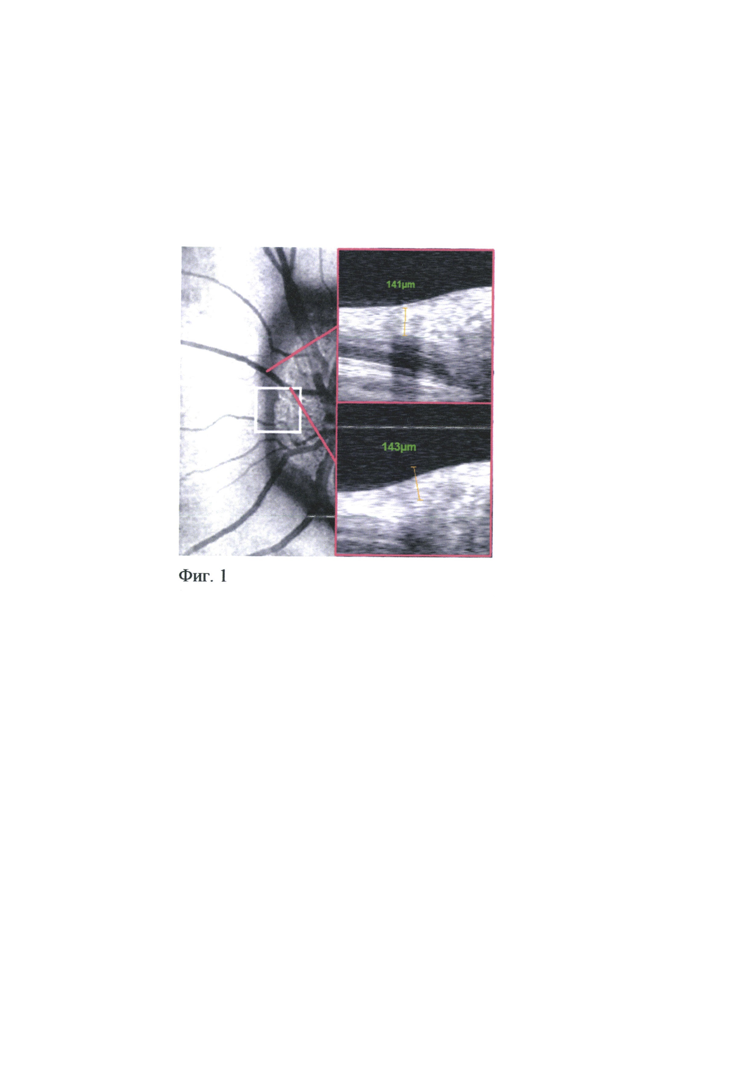 Способ определения структурно-функциональных изменений сетчатки и зрительного нерва при друзах диска зрительного нерва