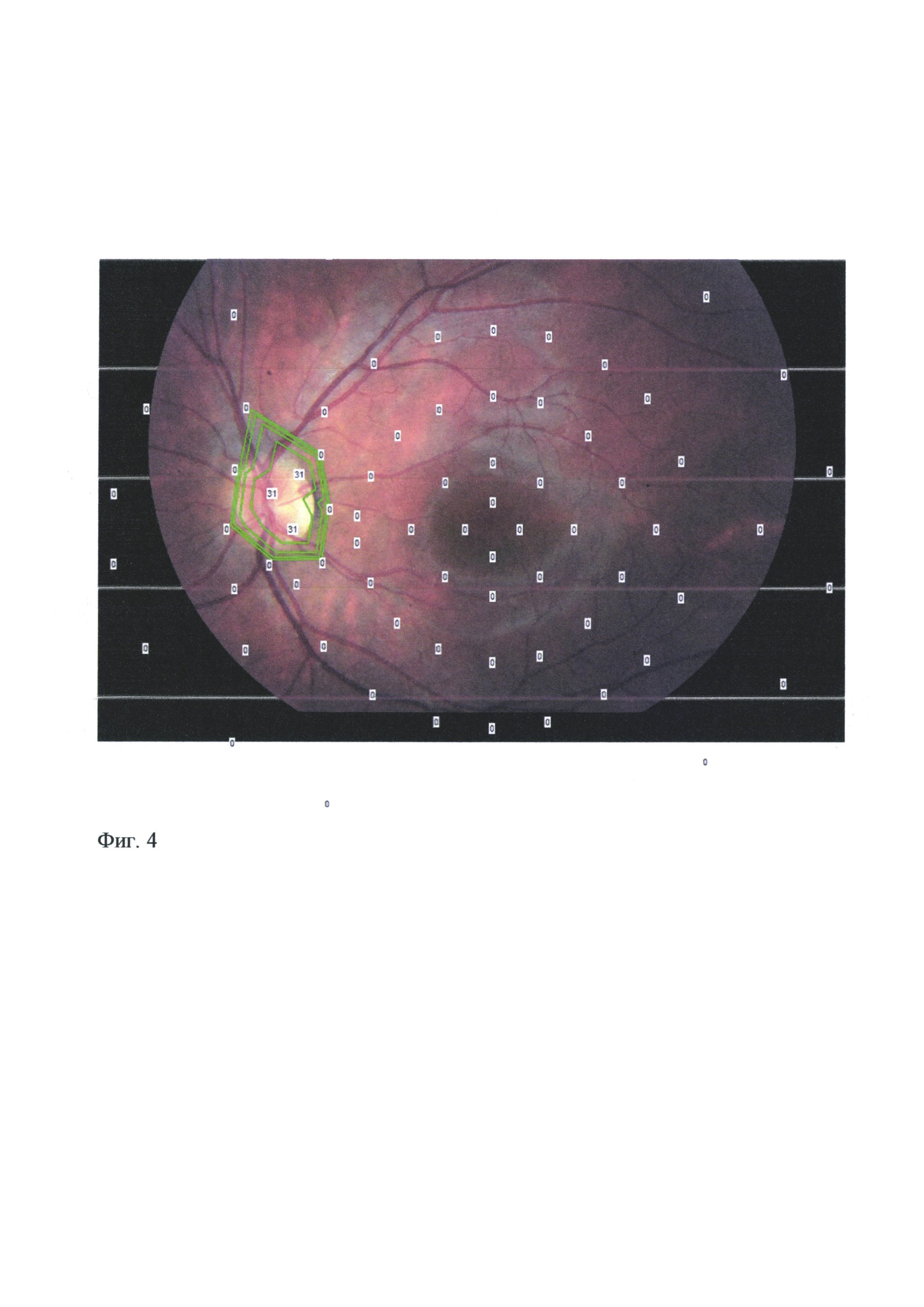 Способ определения структурно-функциональных изменений сетчатки и зрительного нерва при друзах диска зрительного нерва