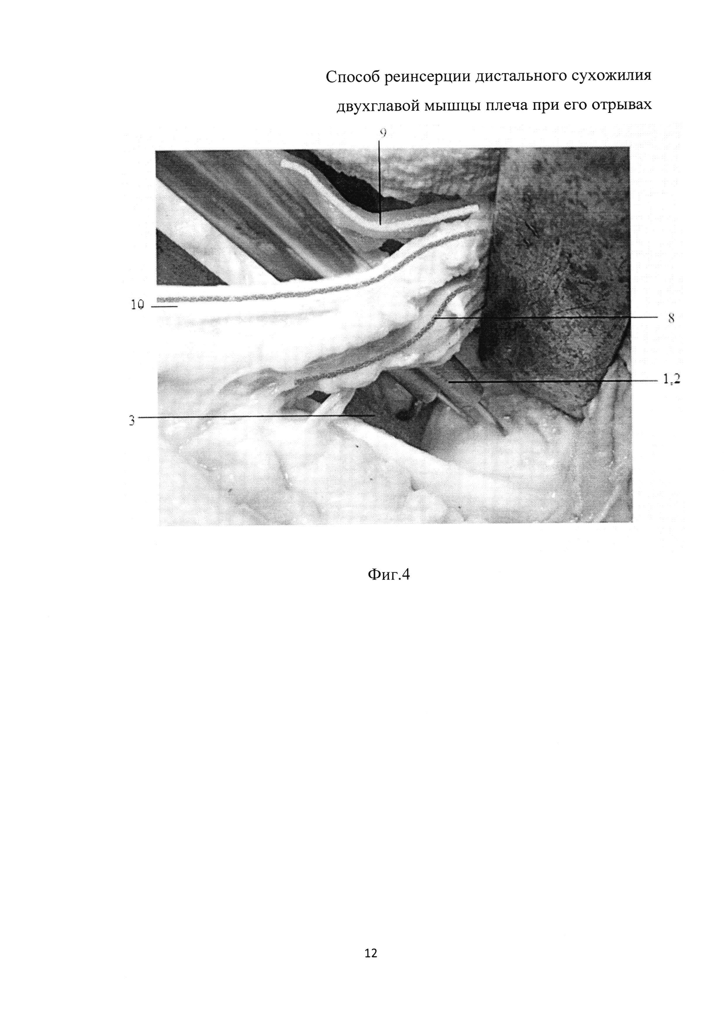 Способ реинсерции дистального сухожилия двуглавой мышцы плеча при его отрывах