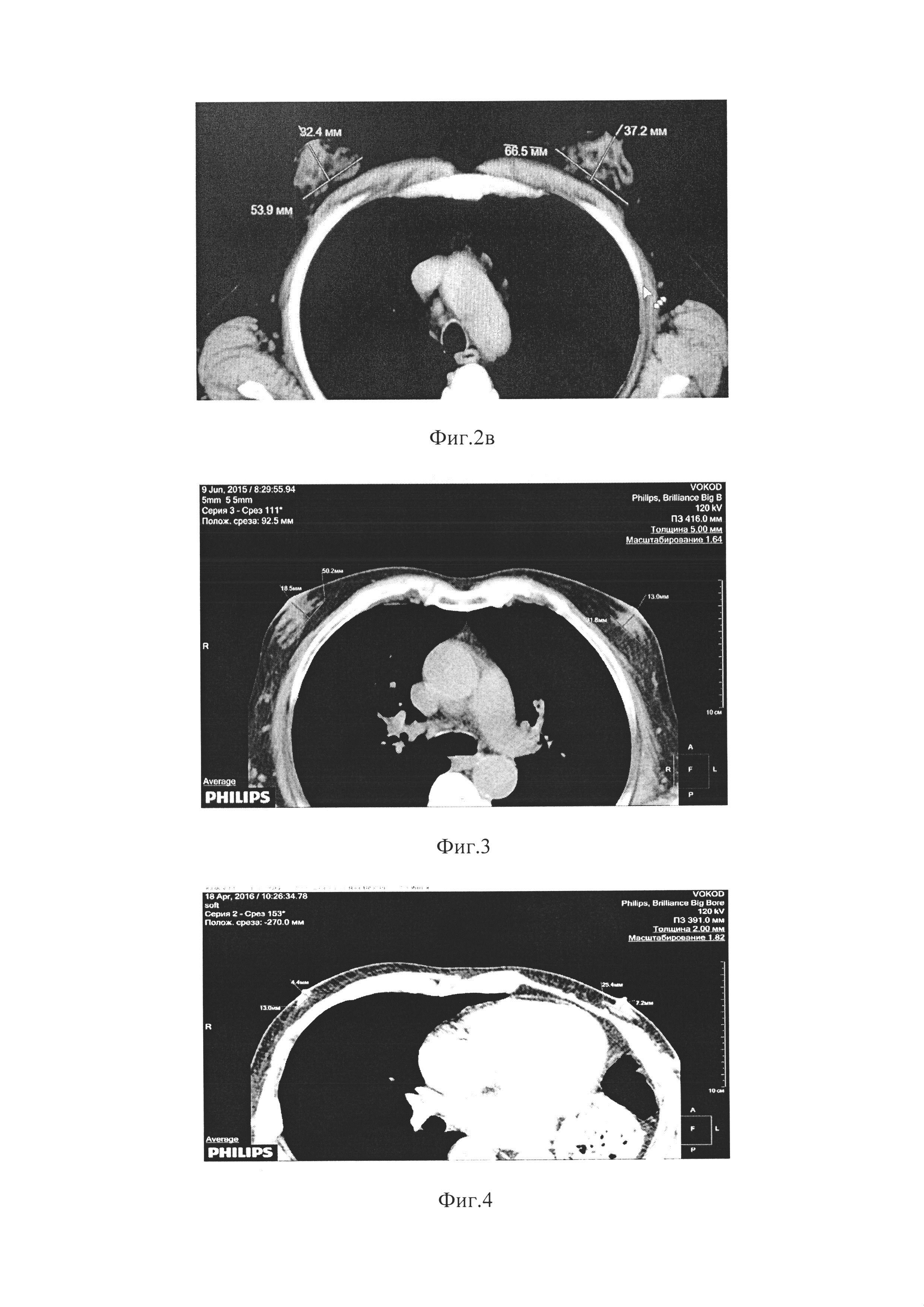 Способ рентгенологической морфометрии фиброгландулярного комплекса и степени развития железистой ткани при диффузной форме гинекомастии у мужчин