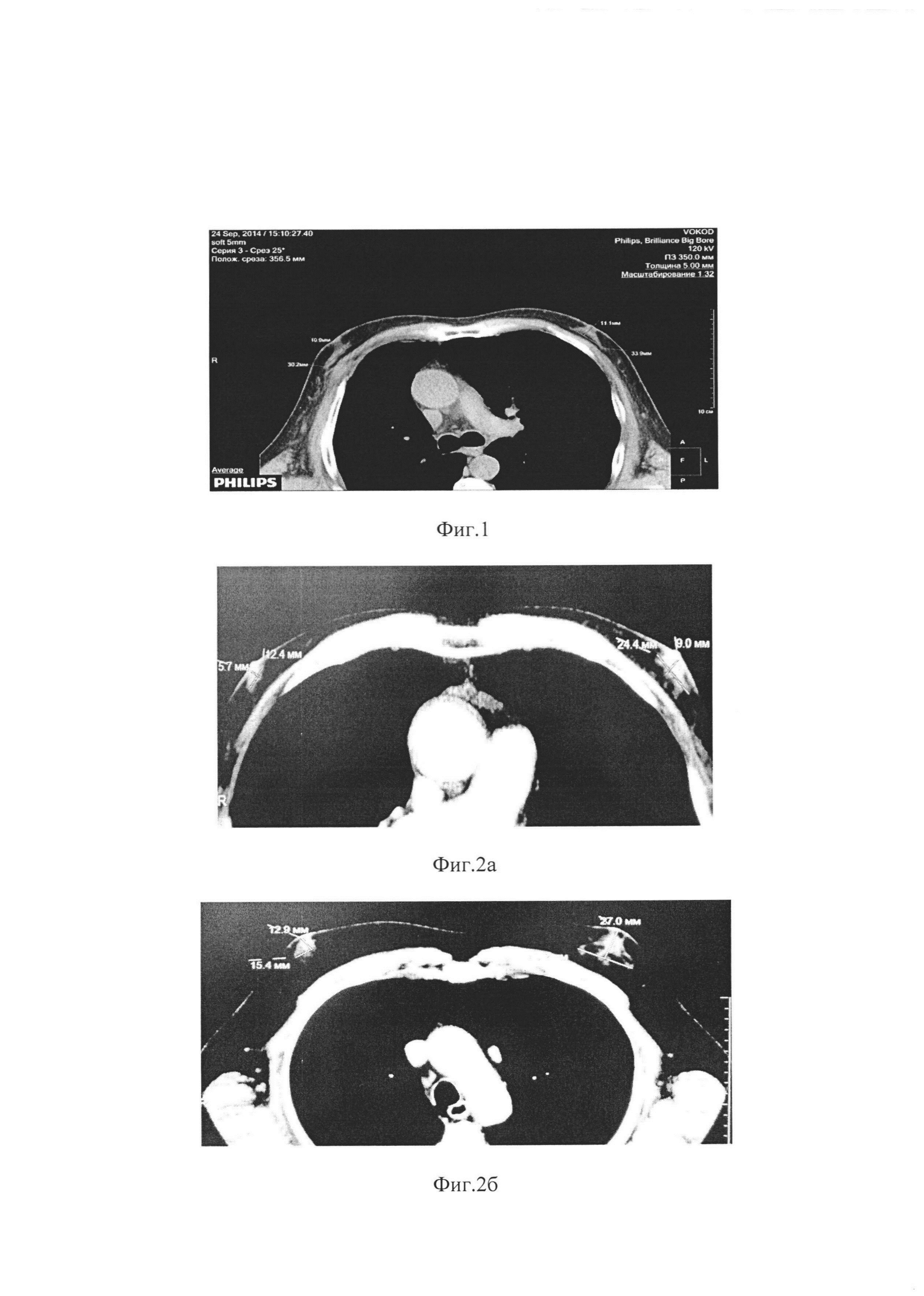 Способ рентгенологической морфометрии фиброгландулярного комплекса и степени развития железистой ткани при диффузной форме гинекомастии у мужчин
