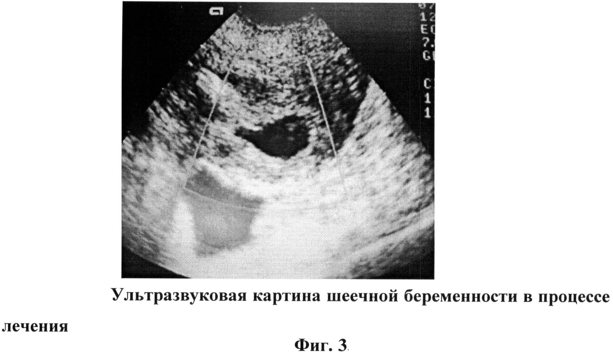 увеличивается ли грудь при внематочной беременности фото 84