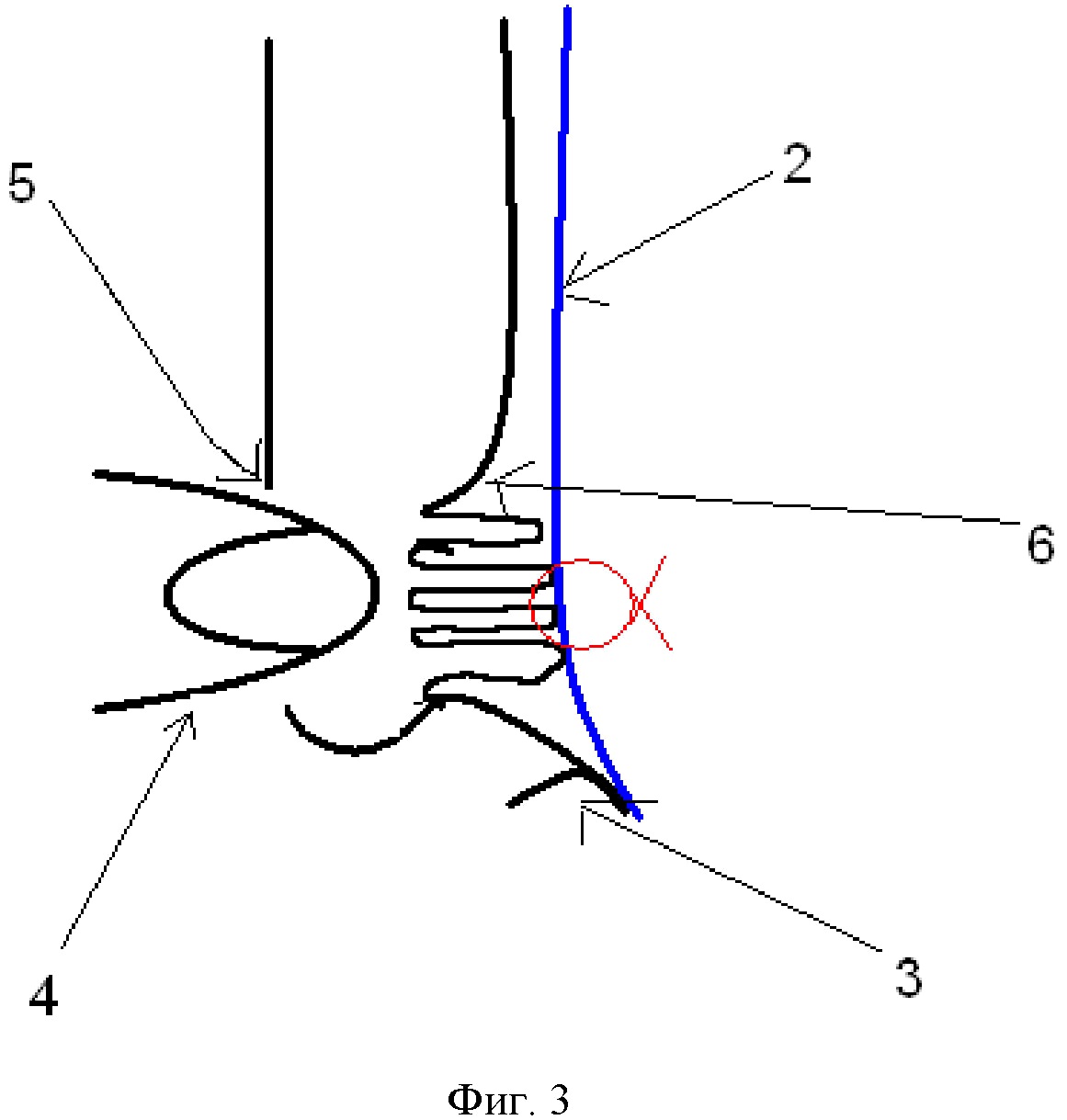 Способ профилактики серомы при лапароскопической паховой герниопластике прямой паховой грыжи