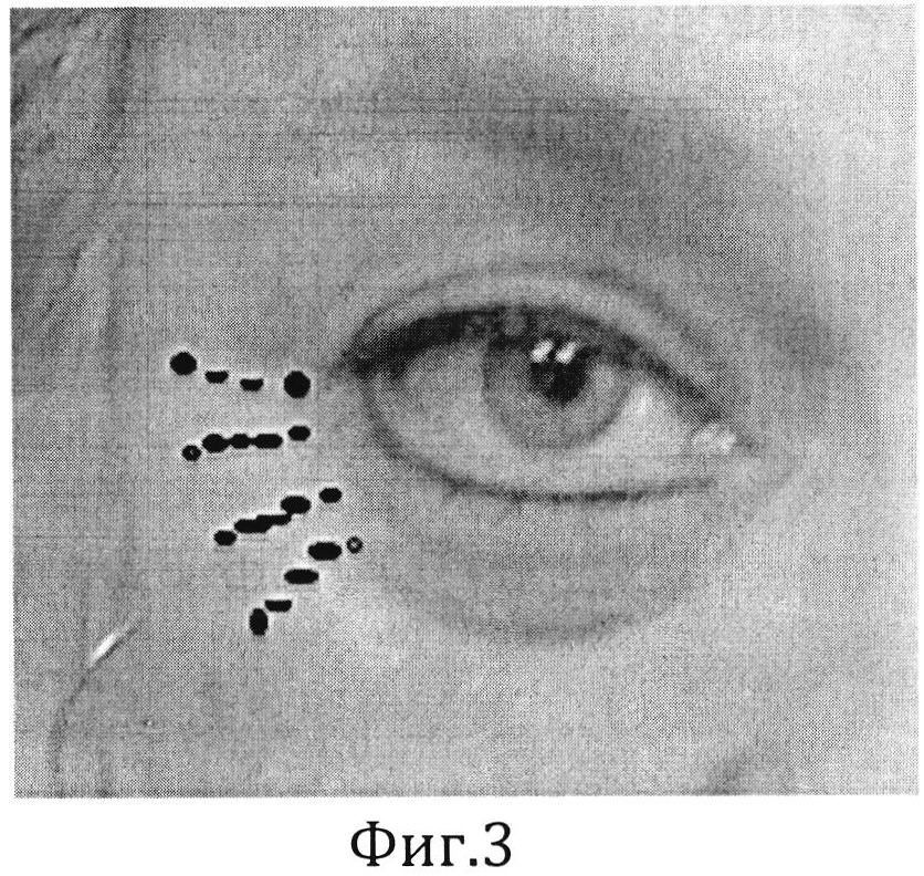 Параорбитальная. Периорбитальная складка денье-Моргана;. Периорбитальный меланоз. Папула периорбитальная зона. Периорбитальная зона вокруг глаз.