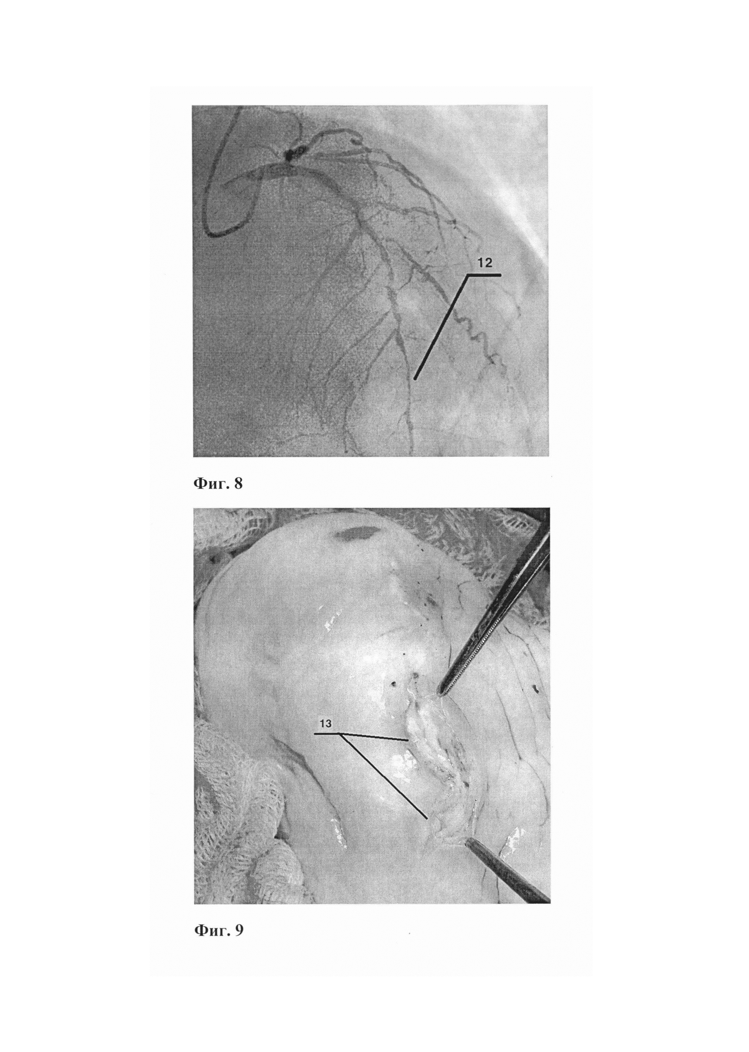Способ открытой эндартерэктомии при диффузном атеросклеротическом поражении передней межжелудочковой артерии
