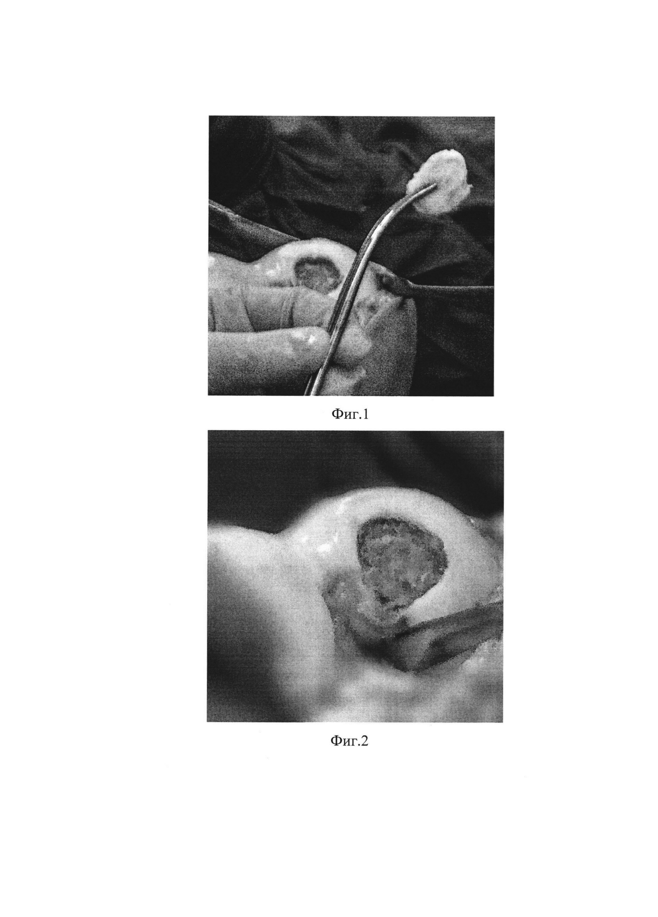 Способ хирургического лечения костно-хрящевых дефектов мыщелков бедренной кости