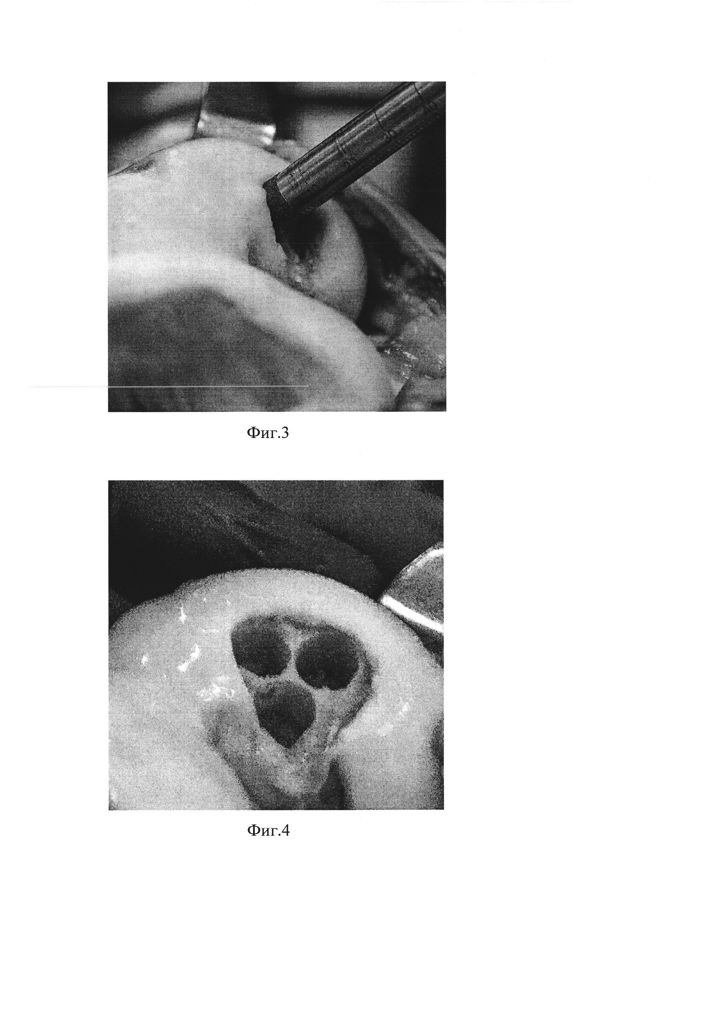 Способ хирургического лечения костно-хрящевых дефектов мыщелков бедренной кости