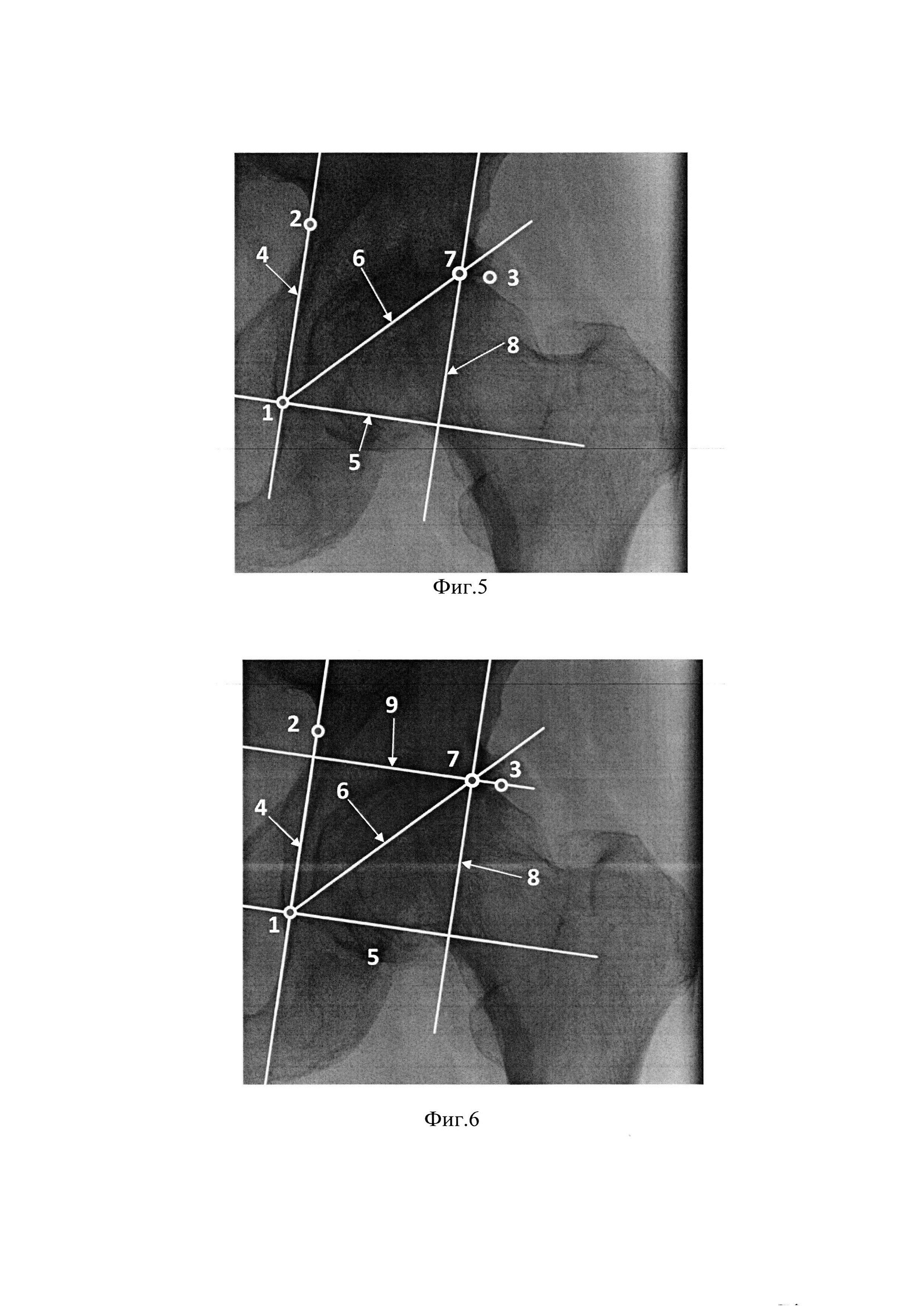 Способ определения места имплантации вертлужного компонента при планировании эндопротезирования тазобедренного сустава