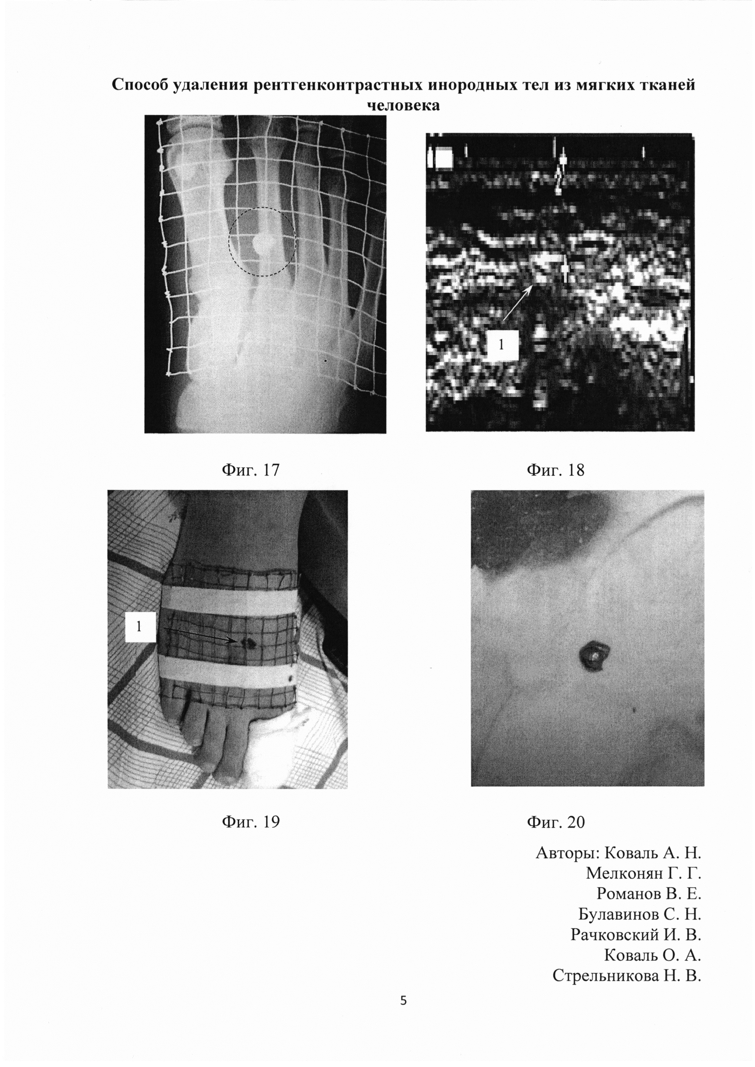 Способ удаления рентгенконтрастных инородных тел из мягких тканей человека
