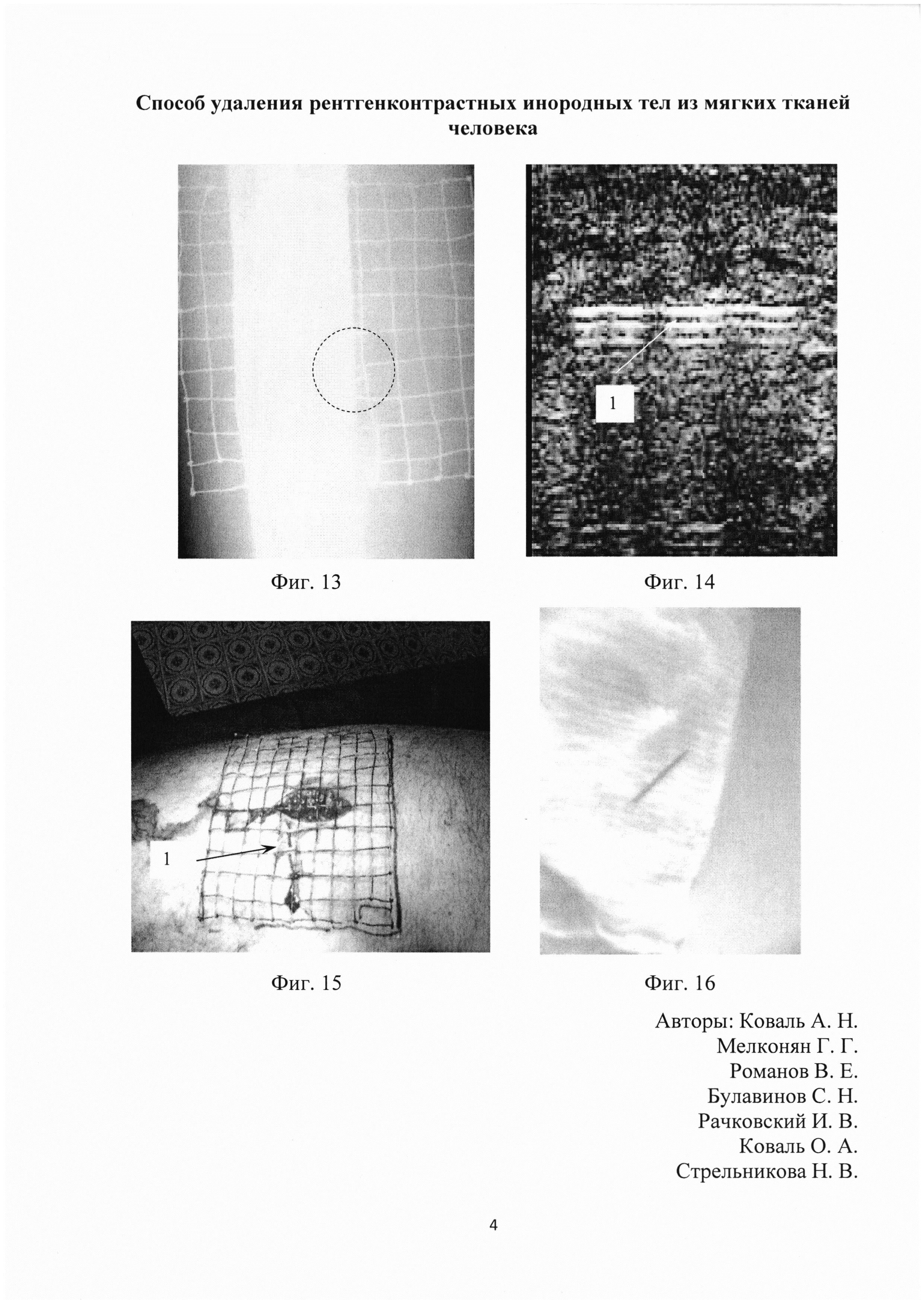 Способ удаления рентгенконтрастных инородных тел из мягких тканей человека