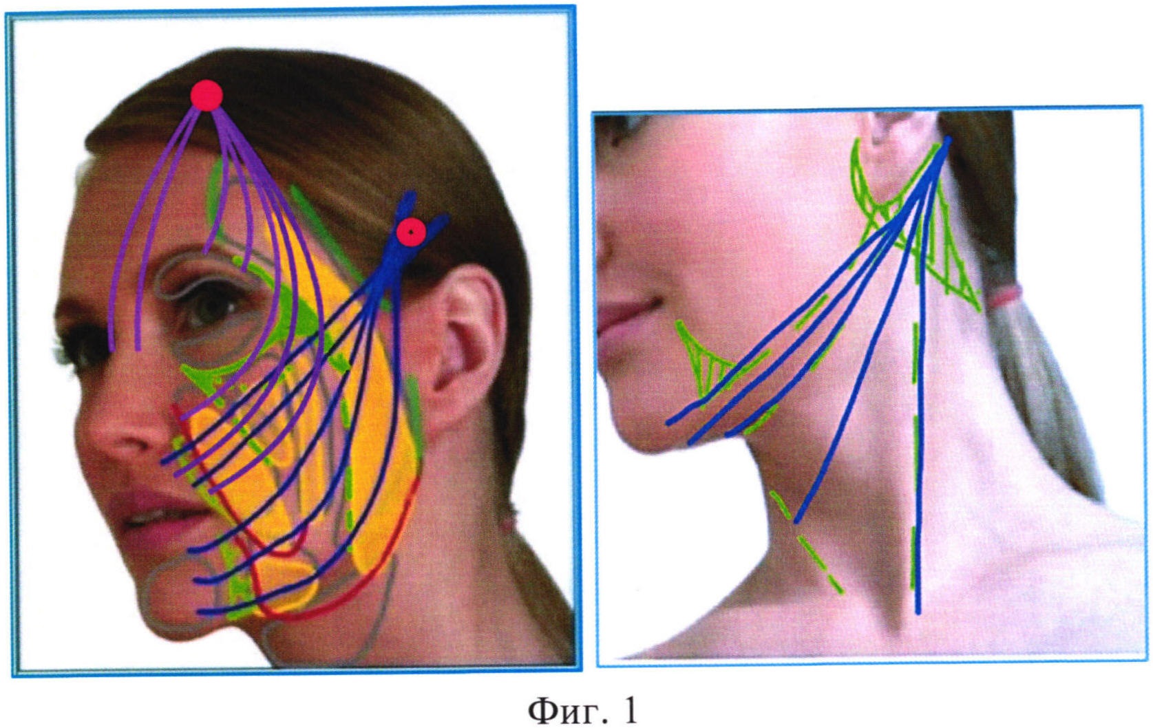 Малоинвазивный одномоментный способ фиксации мягких тканей лица и шеи