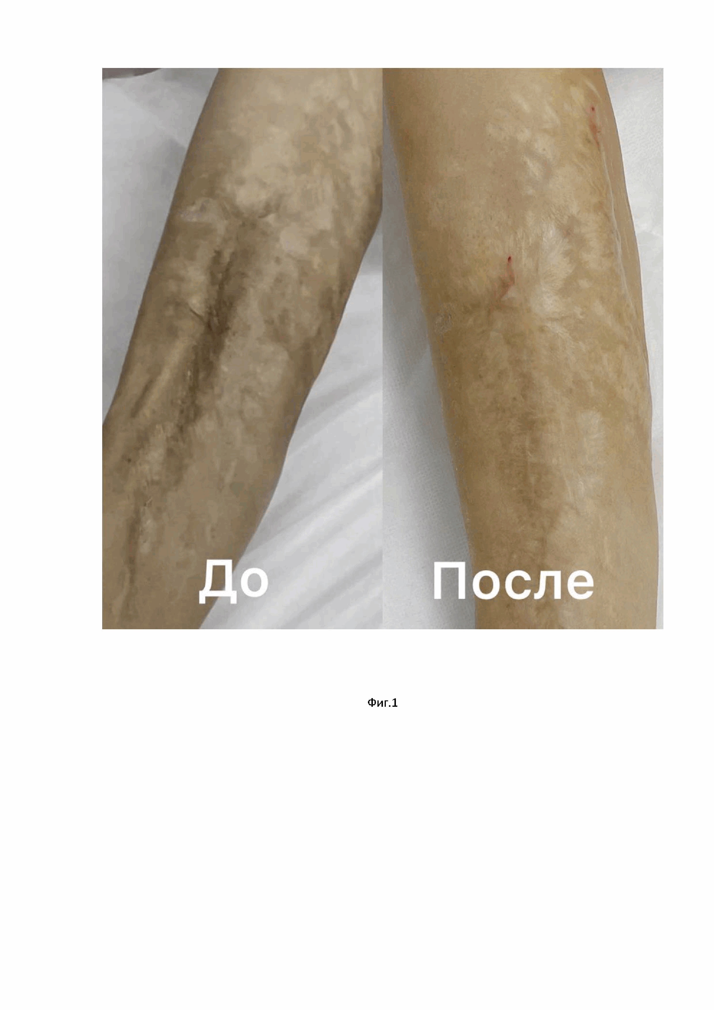 Способ лечения рубцов кожи, спаянных с подлежащими тканями