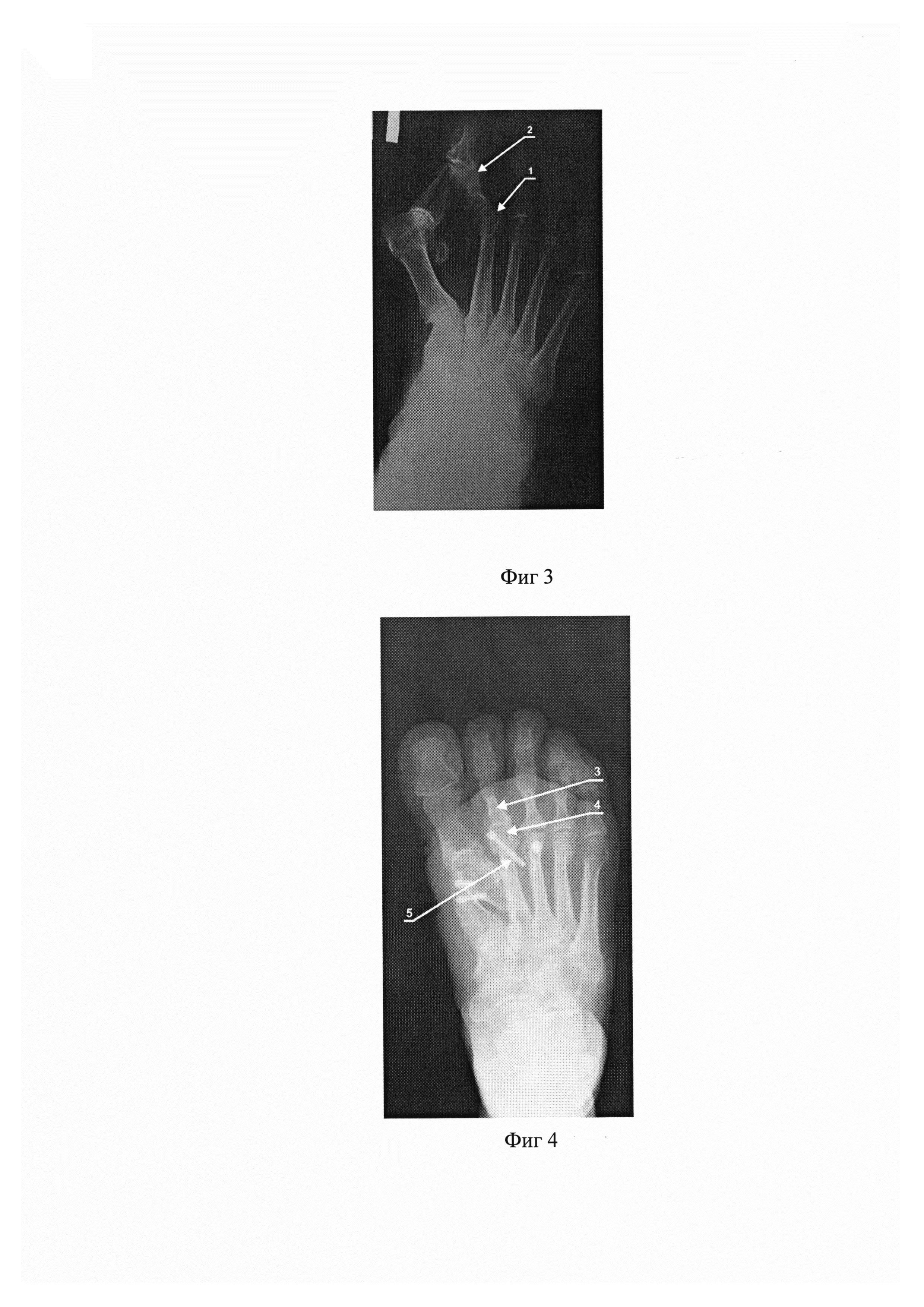 Способ устранения неригидных молоткообразных деформаций 2, 3, 4 пальцев при поперечном плоскостопии