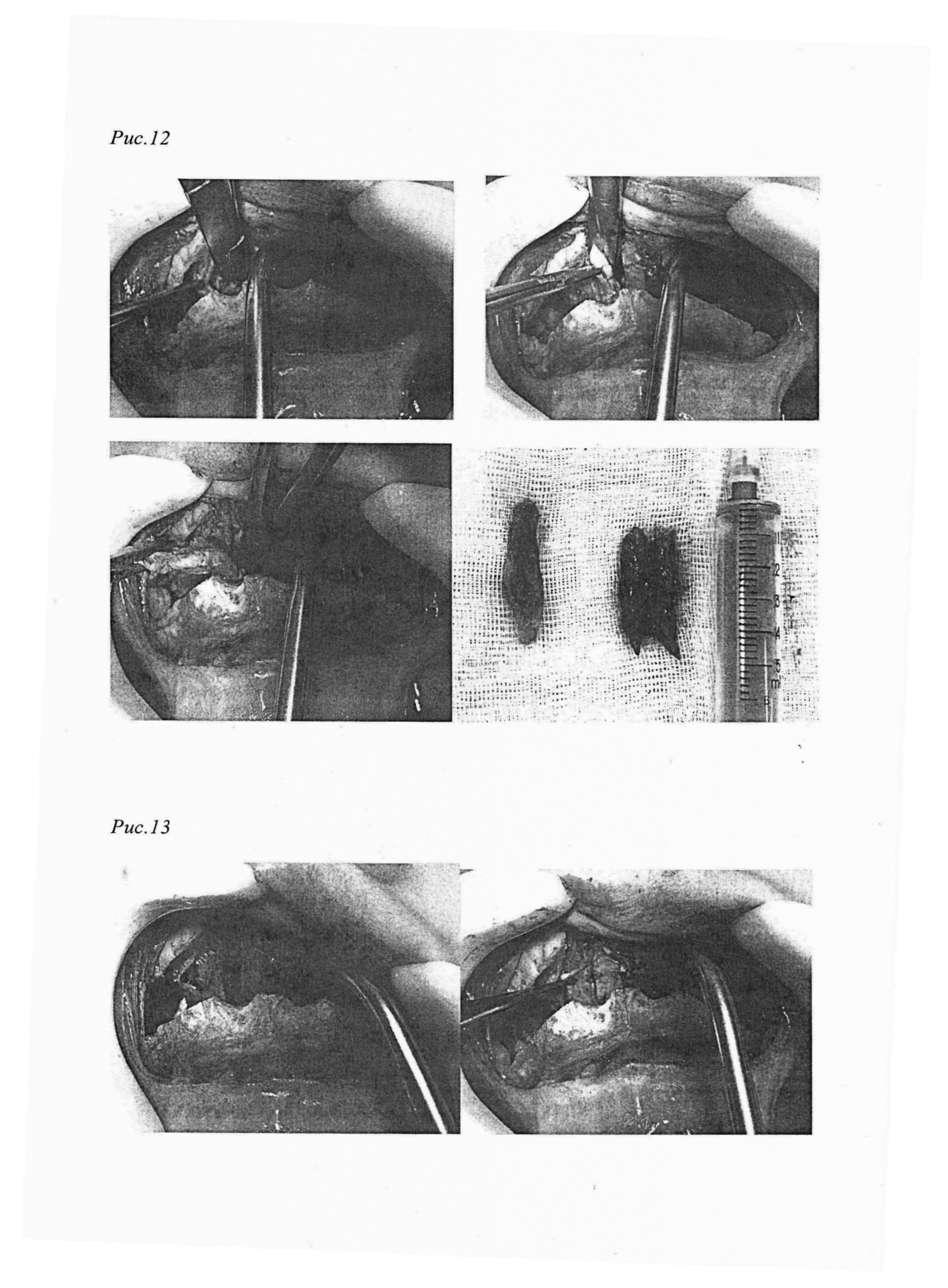 Способ лечения пациентов с гнатическими формами зубочелюстных аномалий, нарушением носового дыхания и гипертрофией нижних носовых раковин