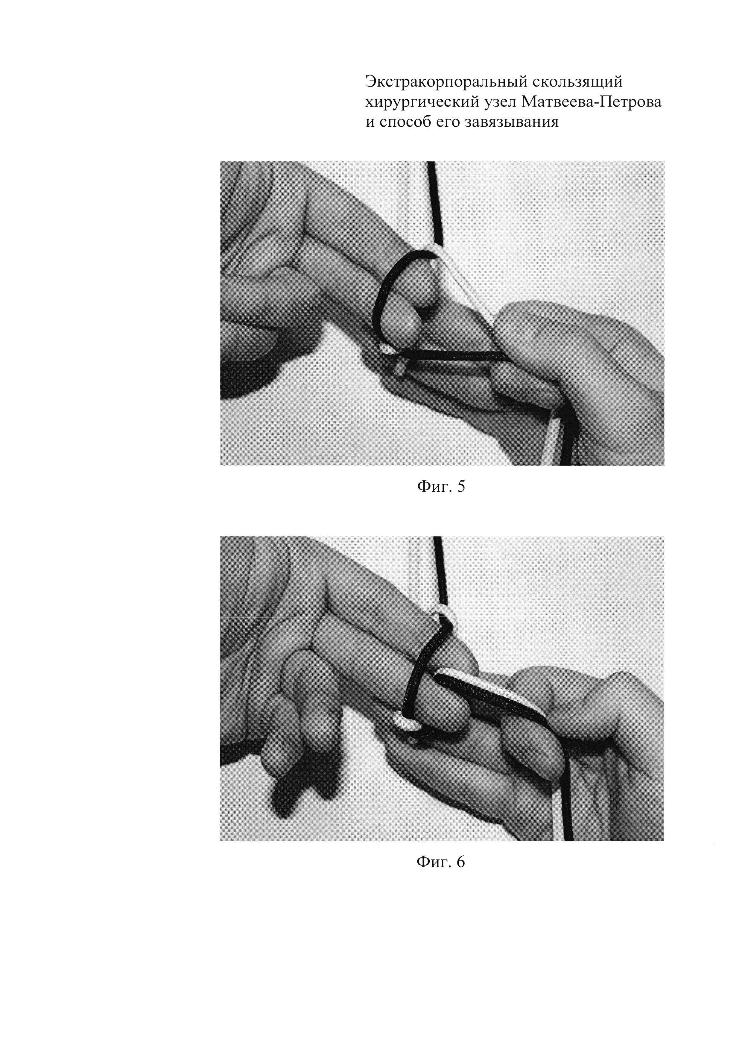 Экстракорпоральный скользящий хирургический узел Матвеева-Петрова и способ его завязывания