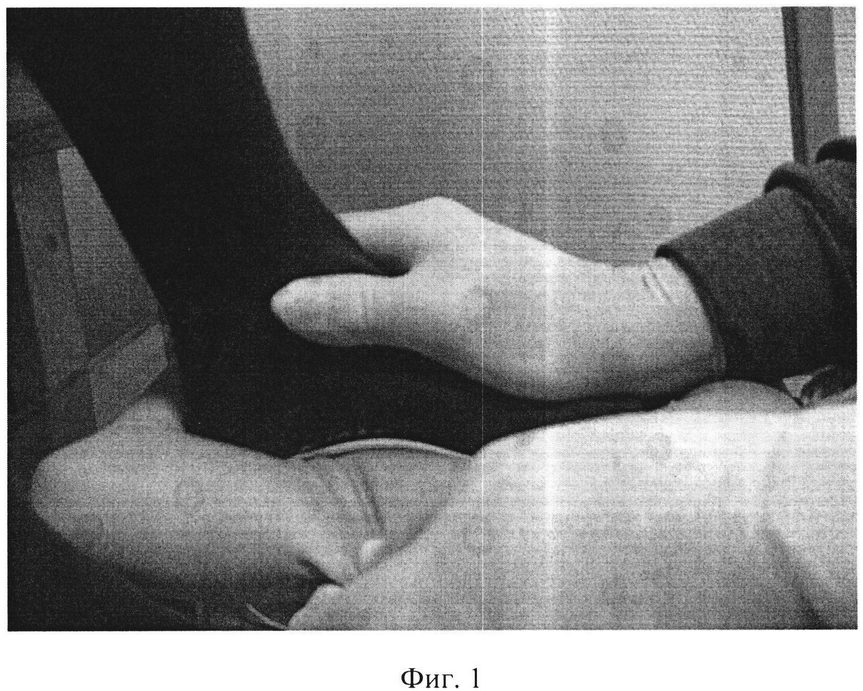 Способ изготовления индивидуальной ортопедической стельки при плоско-вальгусной нефиксированной деформации стоп