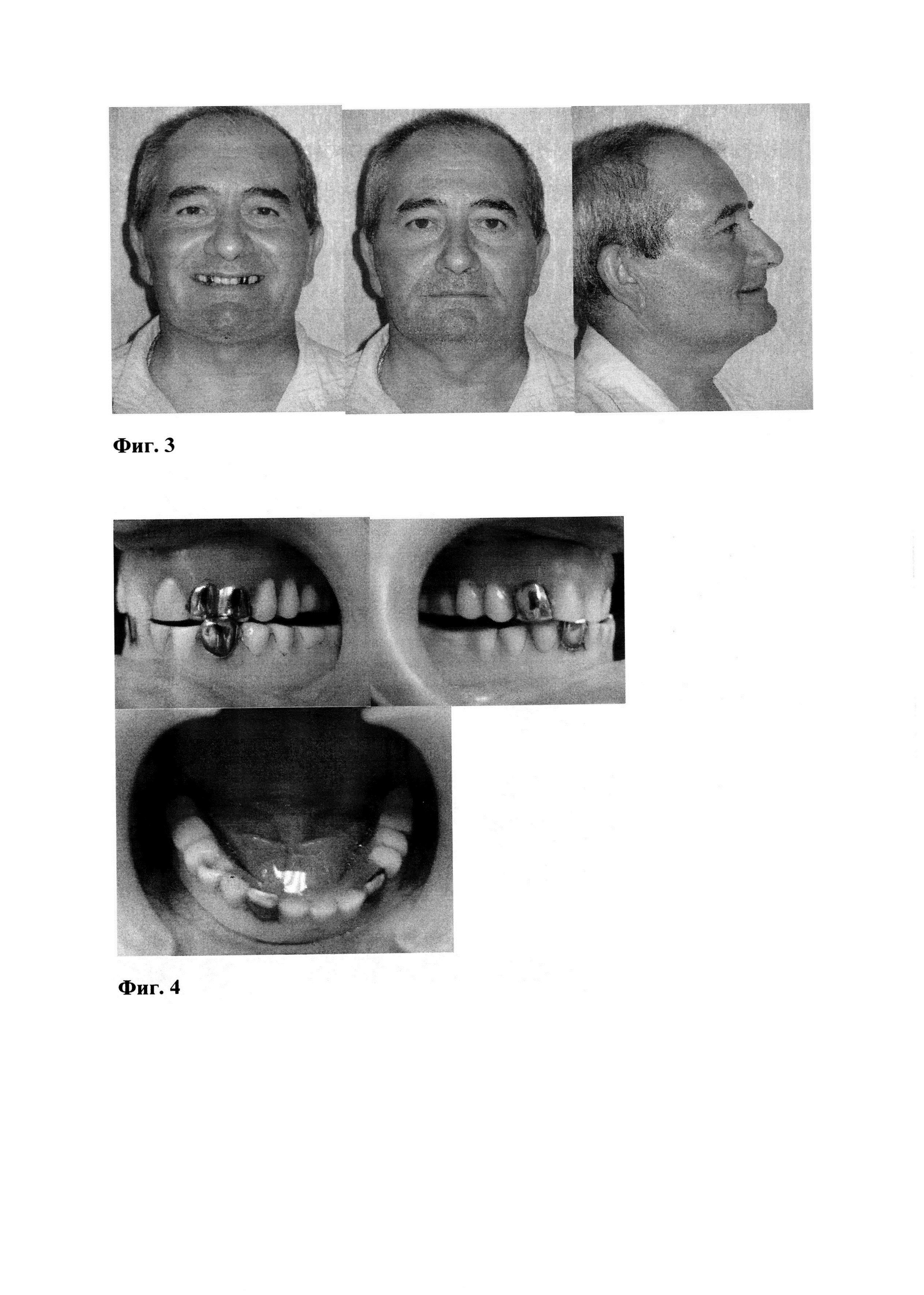 Способ профилактики дисфункции височно-нижнечелюстного сустава у пациентов с полным отсутствием постоянных зубов на верхней и нижней челюсти