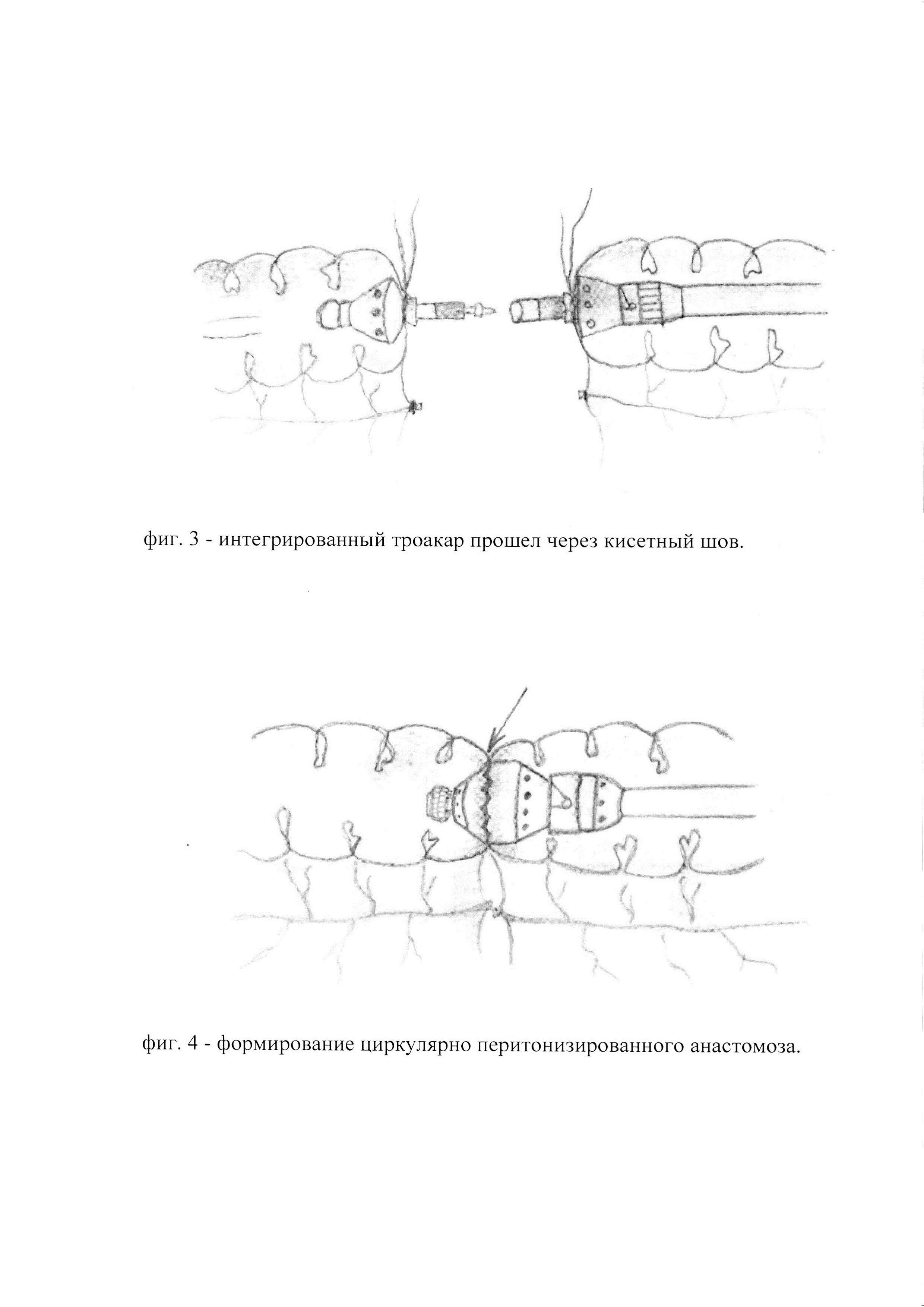 Способ формирования лапароскопического интракорпорального термино-терминального циркулярно-перитонизированного толстокишечного анастомоза