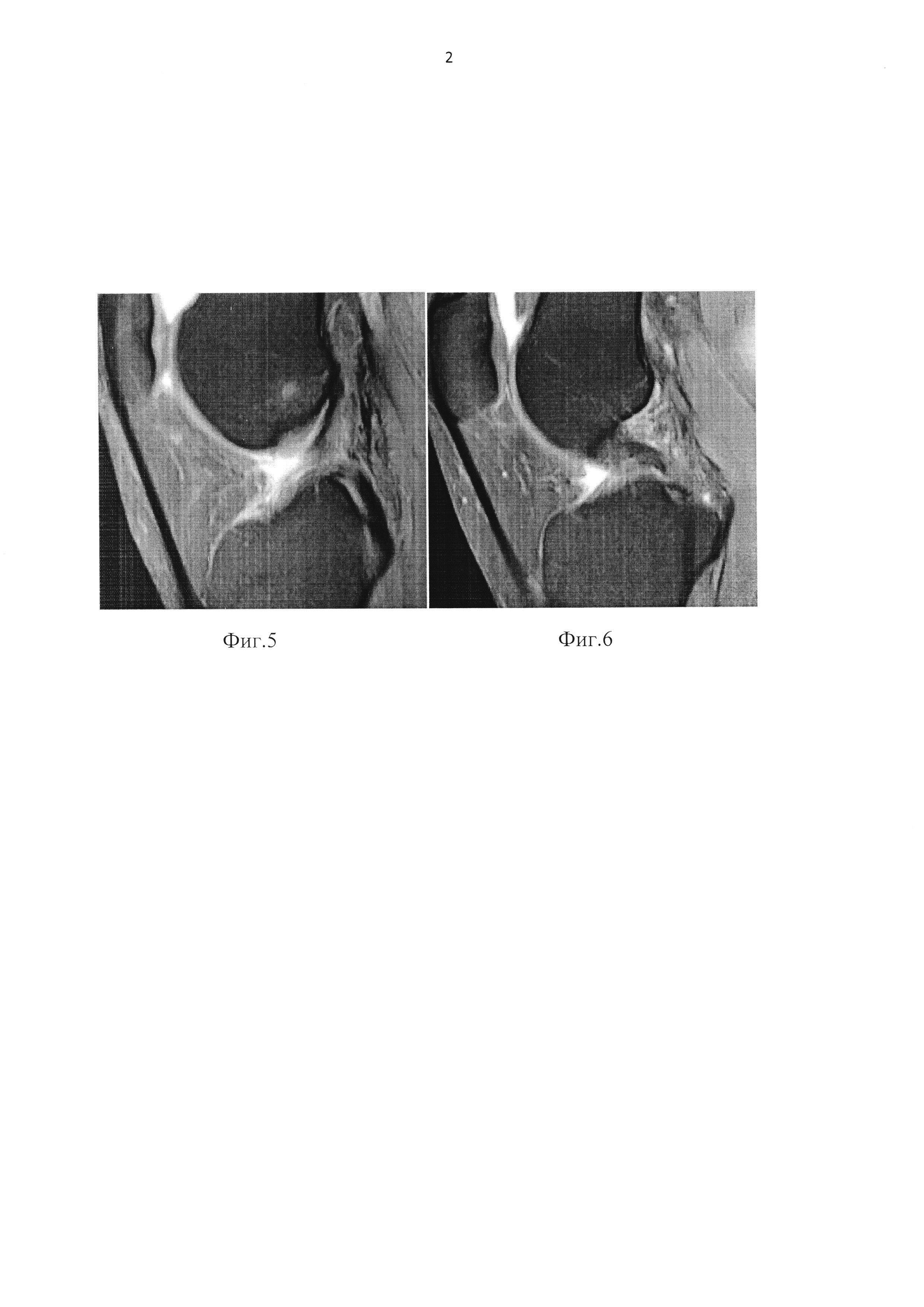 Способ диагностики внутренних структур коленного сустава при магнитно-резонансной томографии