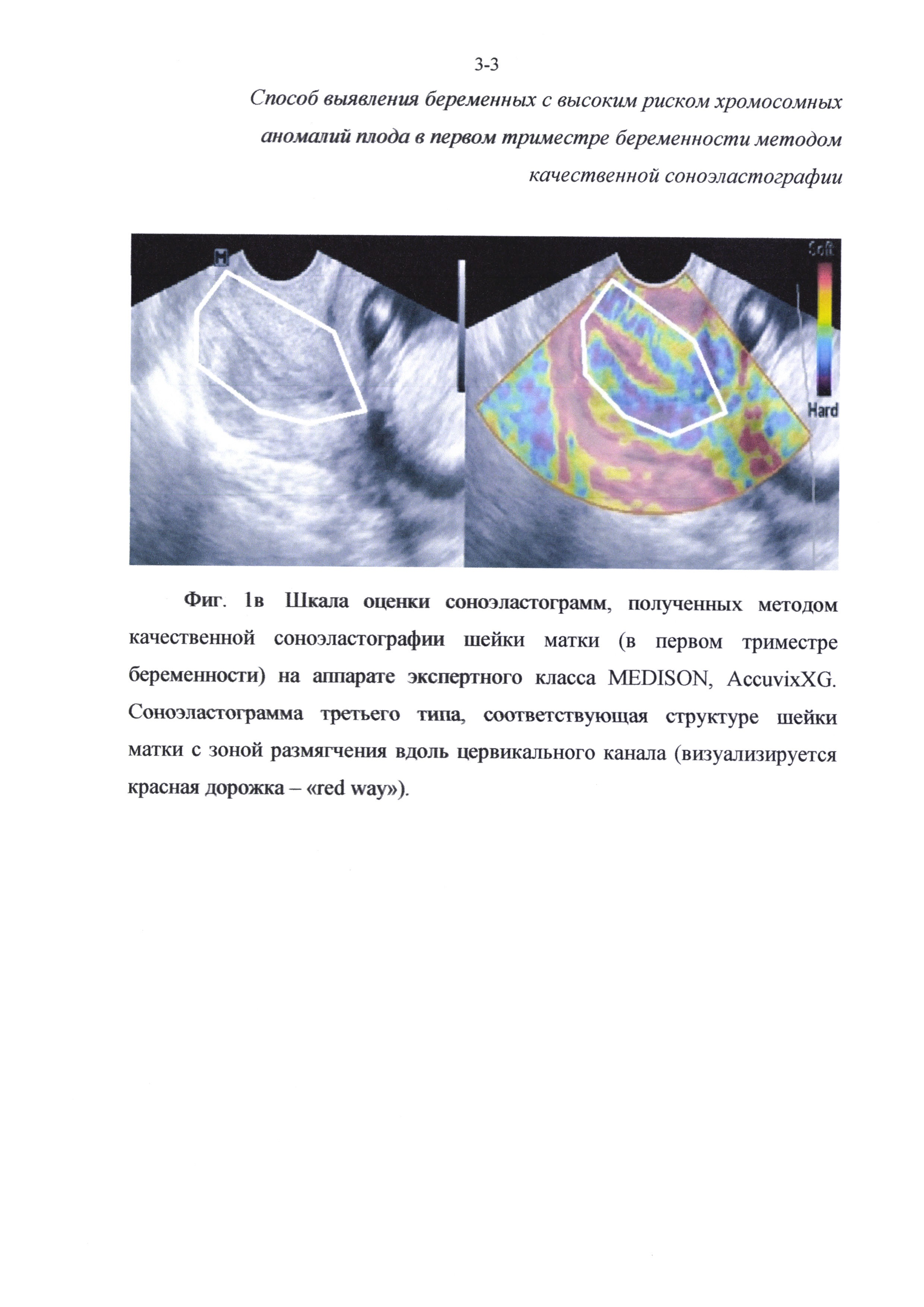 Способ отбора беременных женщин для проведения инвазивной диагностики хромосомных аномалий плода в первом триместре беременности методом качественной соноэластографии