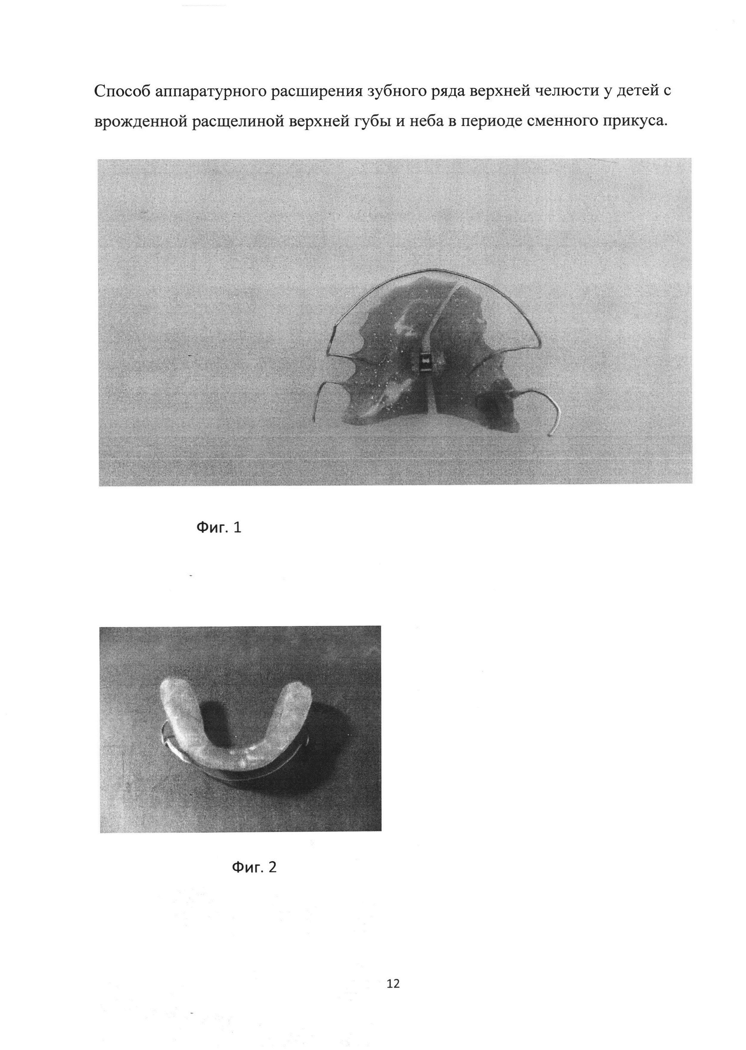 Способ аппаратурного расширения зубного ряда верхней челюсти у детей с врождённой расщелиной верхней губы и нёба в периоде сменного прикуса