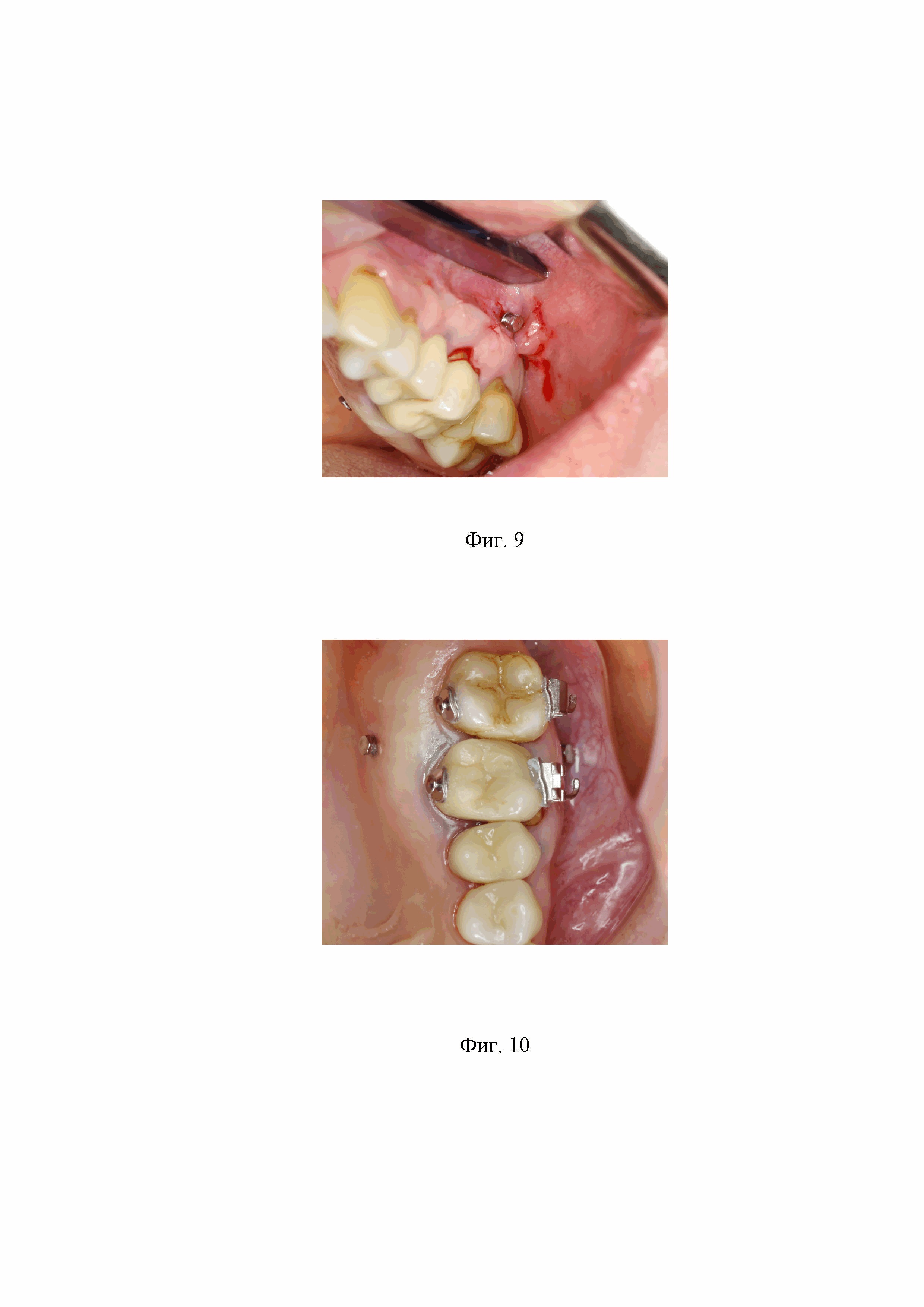 Способ планирования установки ортодонтических имплантатов