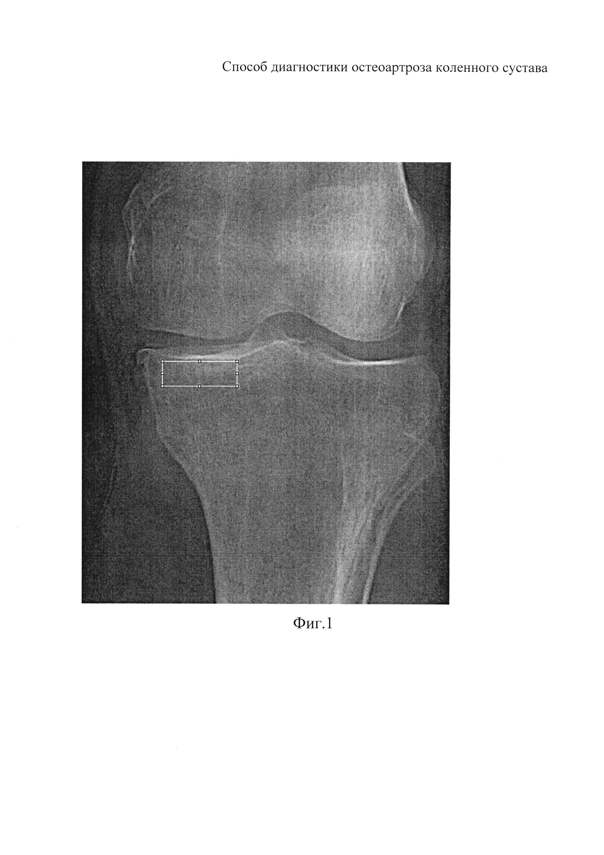 Способ диагностики остеоартроза коленного сустава
