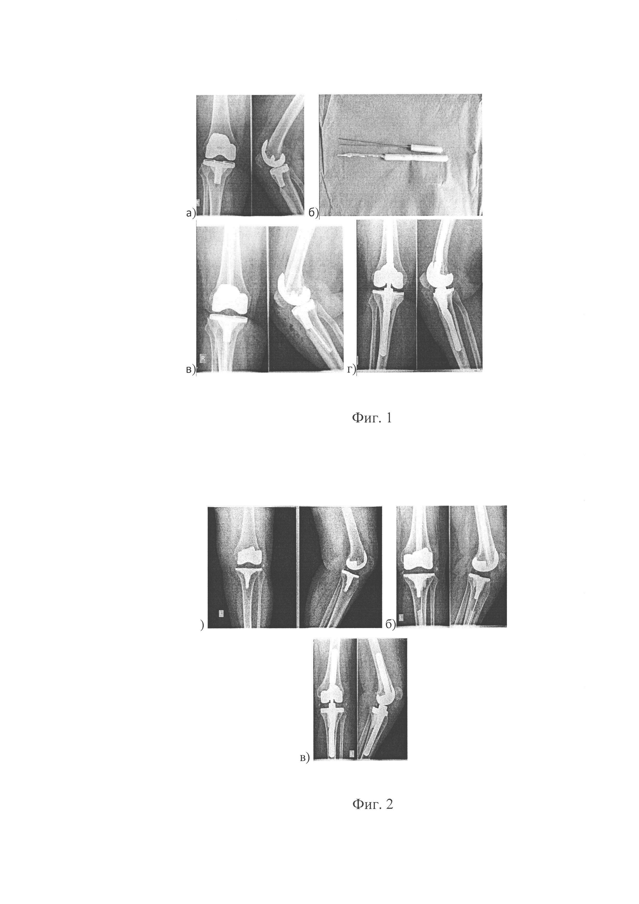 Способ лечения перипротезной инфекции при эндопротезировании коленного сустава