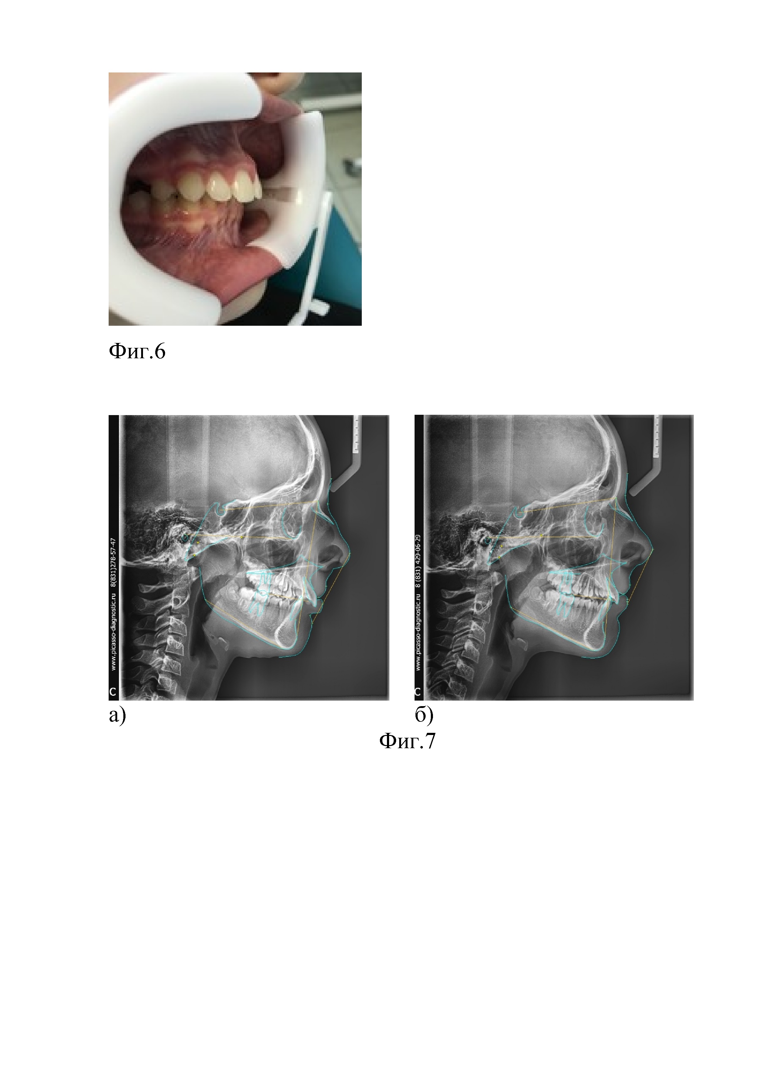 Способ лечения дистального прикуса у детей, обусловленного ретрогнатией нижней челюсти, и устройство для его осуществления