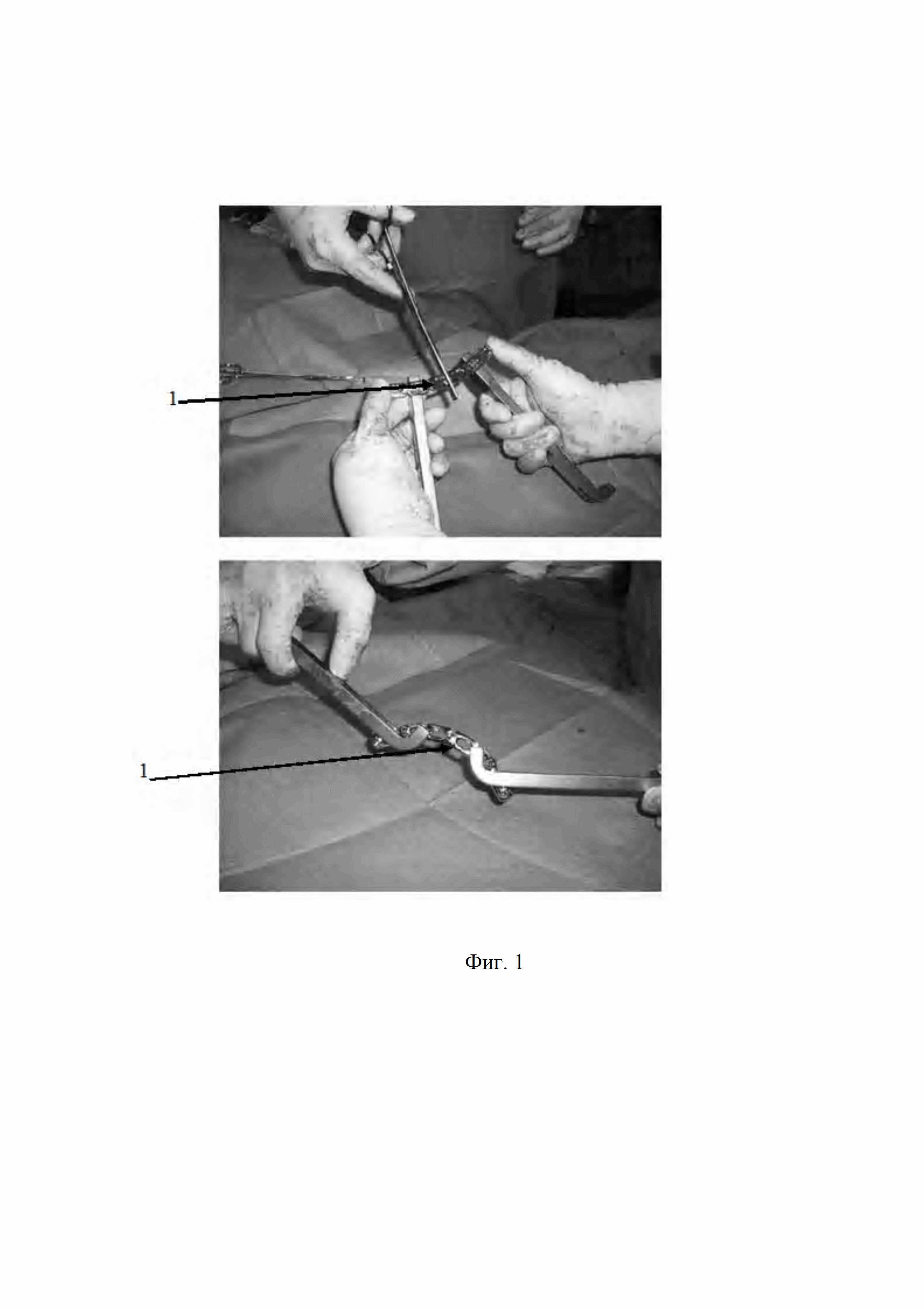 Способ открытой репозиции и фиксации смещенных переломов вертлужной впадины в эксперименте