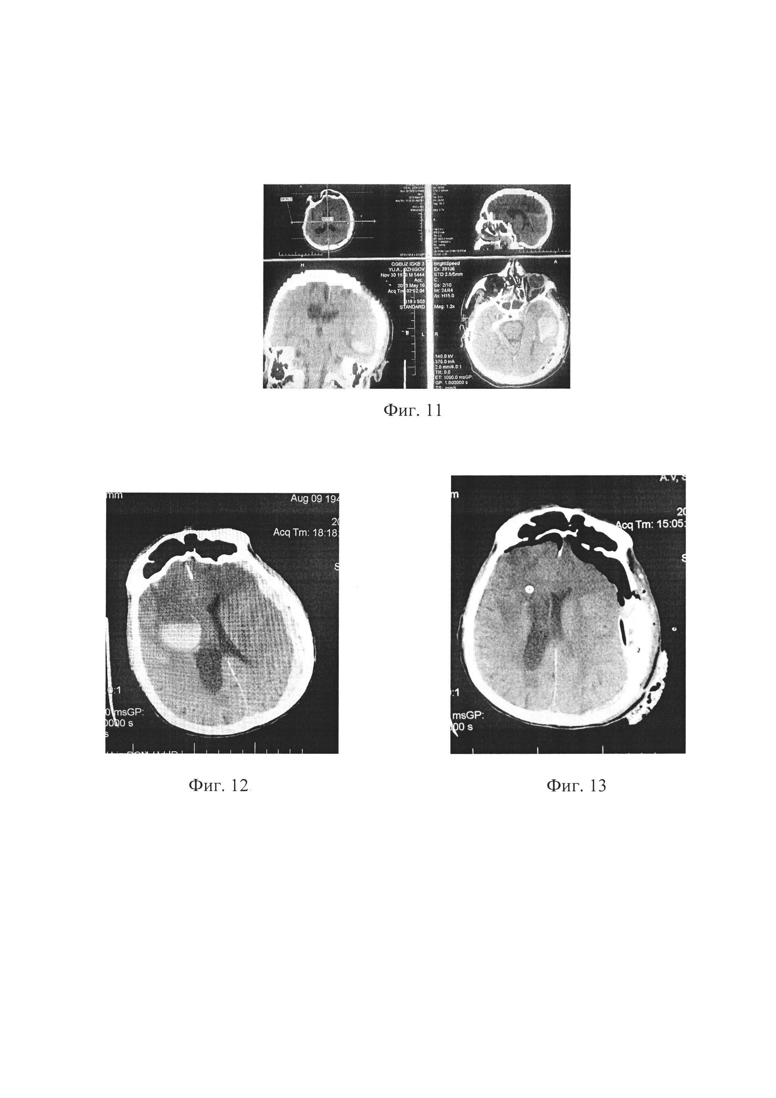 Способ прогнозирования ответной реакции головного мозга на удаление острой травматической внутричерепной гематомы