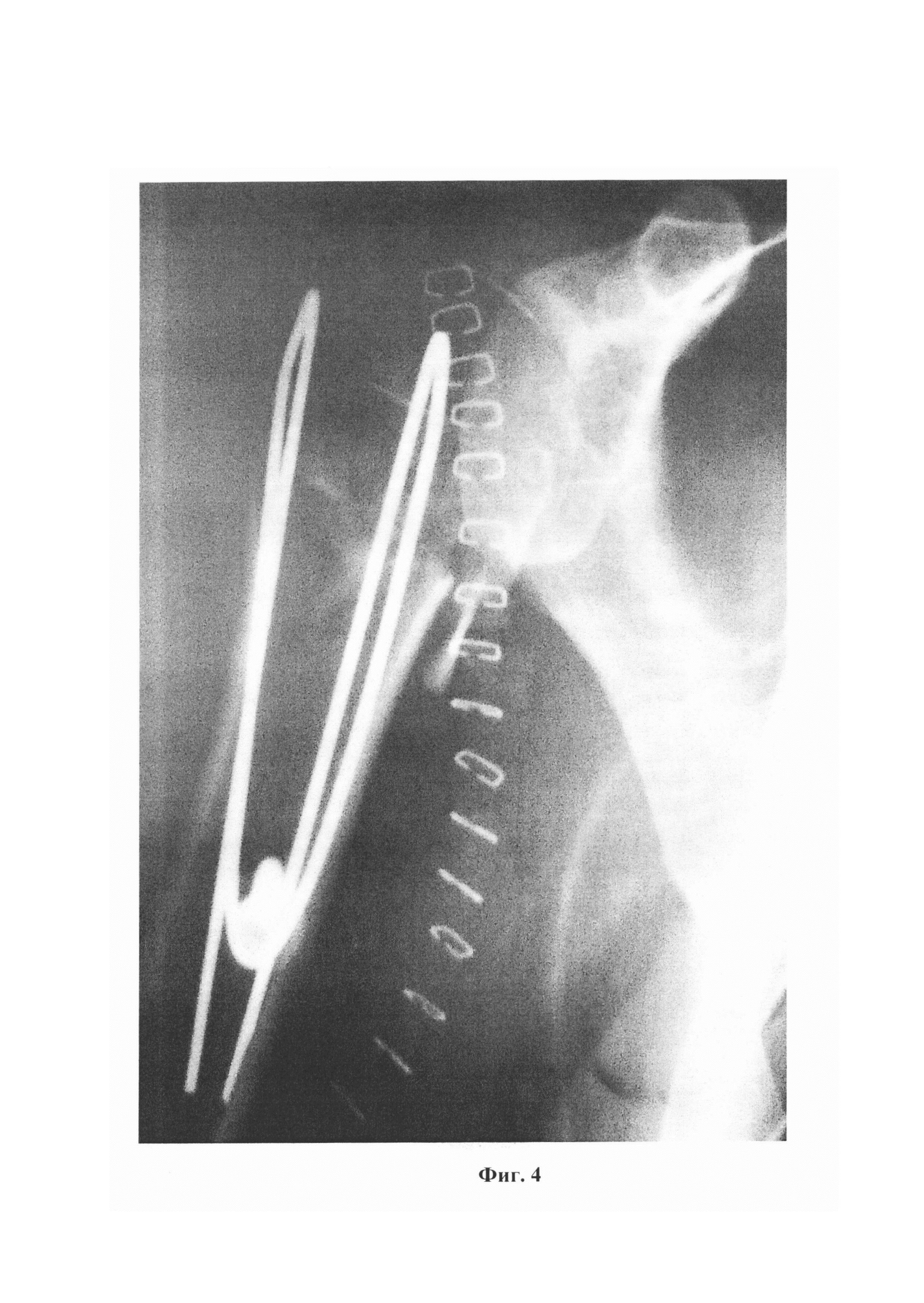 Способ остеосинтеза переломов хирургической шейки плечевой кости