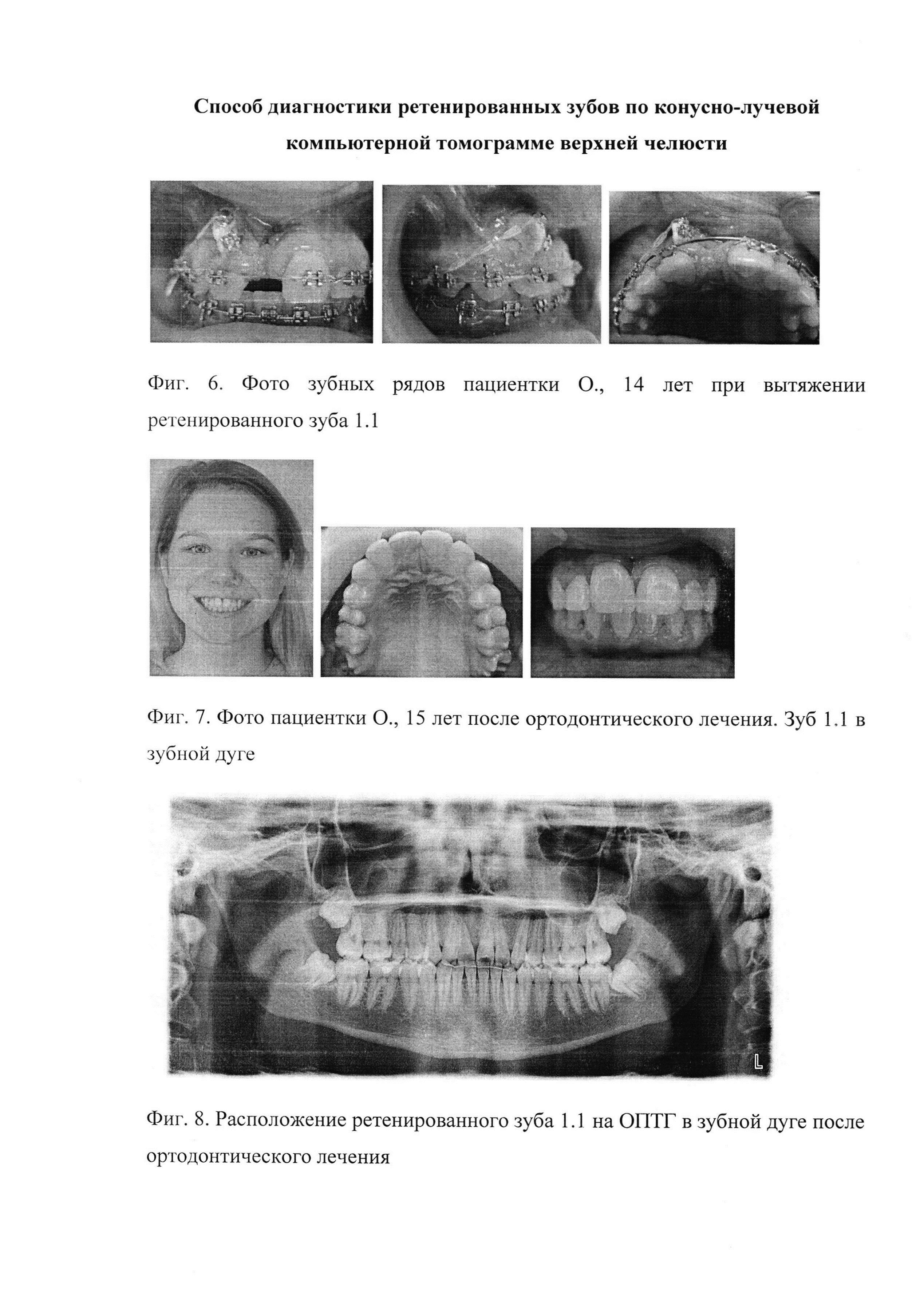 Способ диагностики ретенированных зубов по конусно-лучевой компьютерной томограмме верхней челюсти