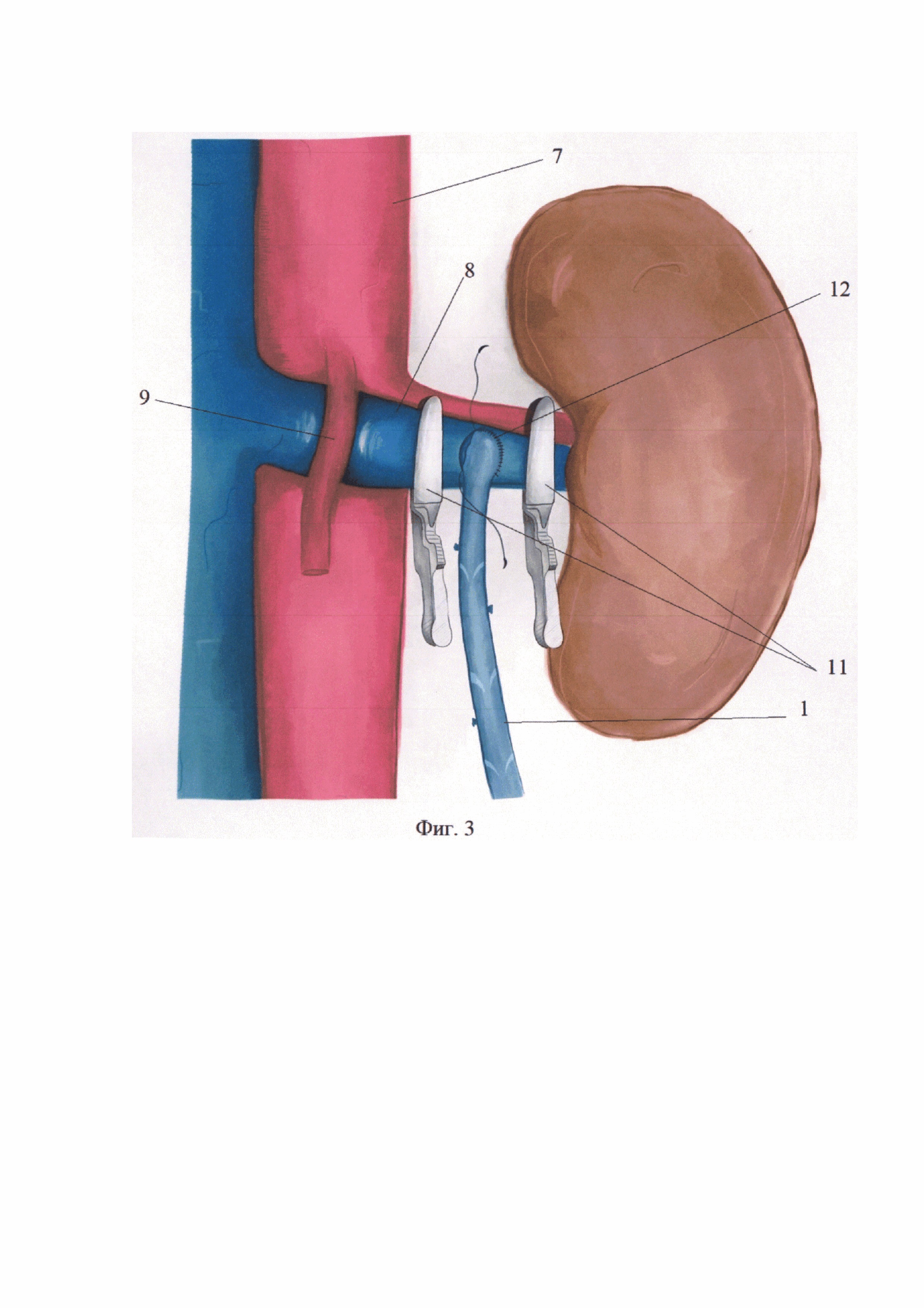 Способ хирургического лечения аорто-мезентерального пинцета