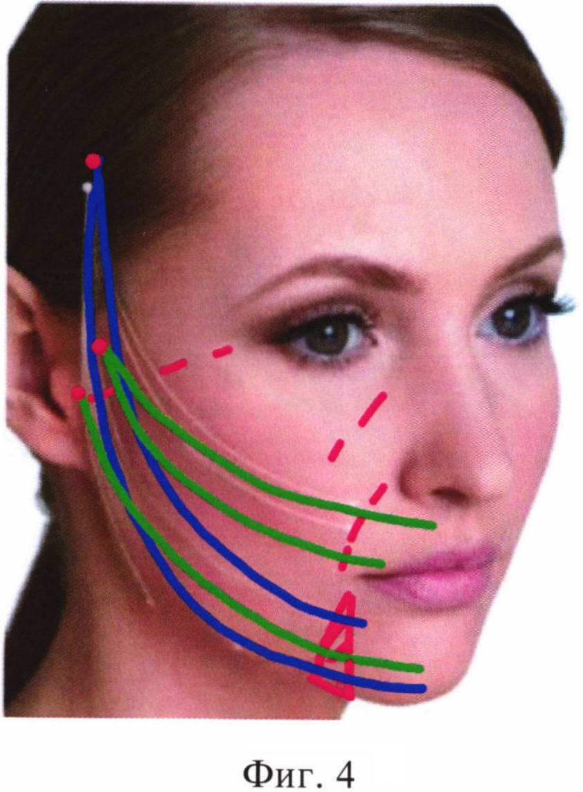 Малоинвазивный способ фиксации связок поверхностной мышечно-апоневротической системы лица