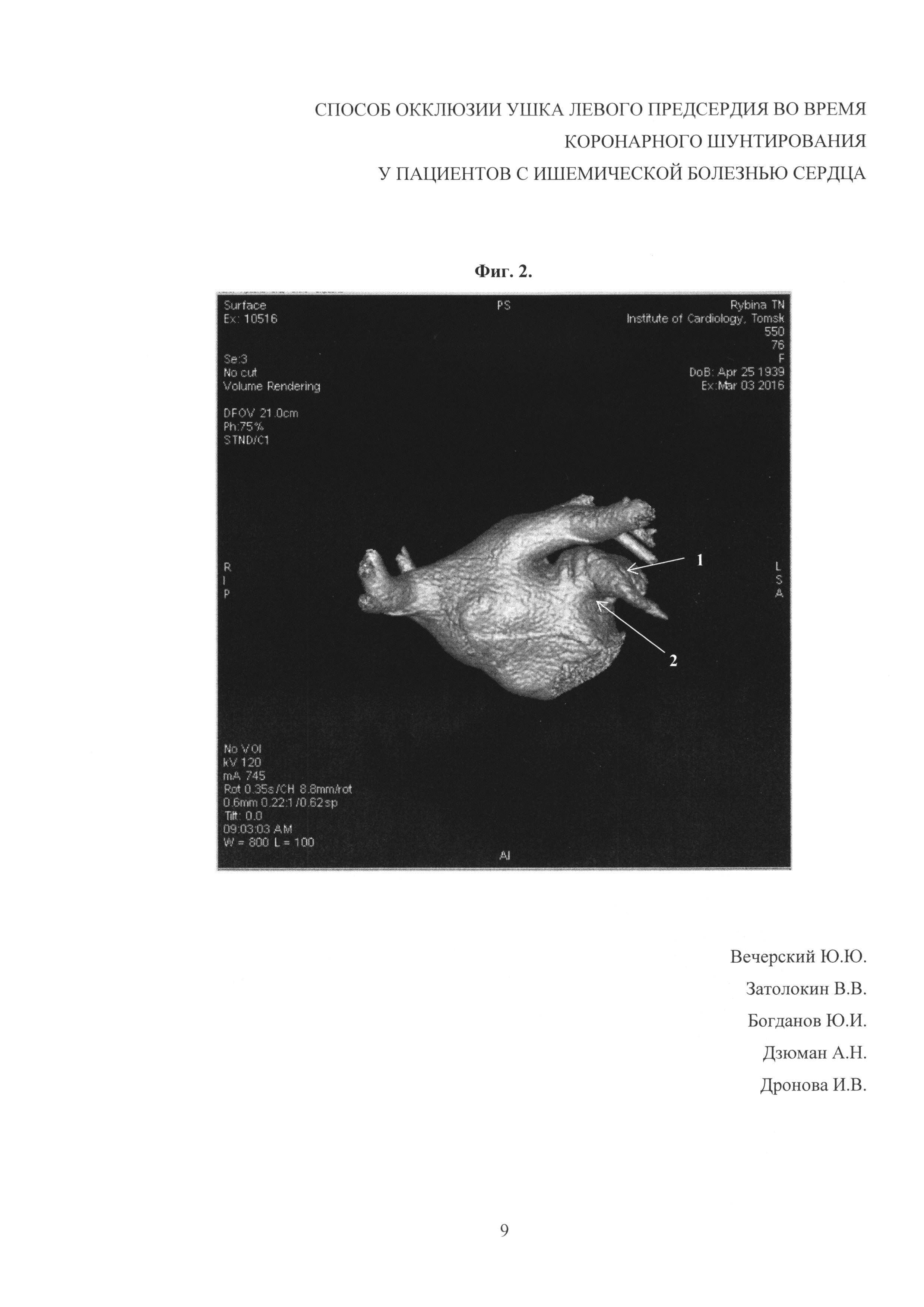 Способ окклюзии ушка левого предсердия во время коронарного шунтирования у пациентов с ишемической болезнью сердца