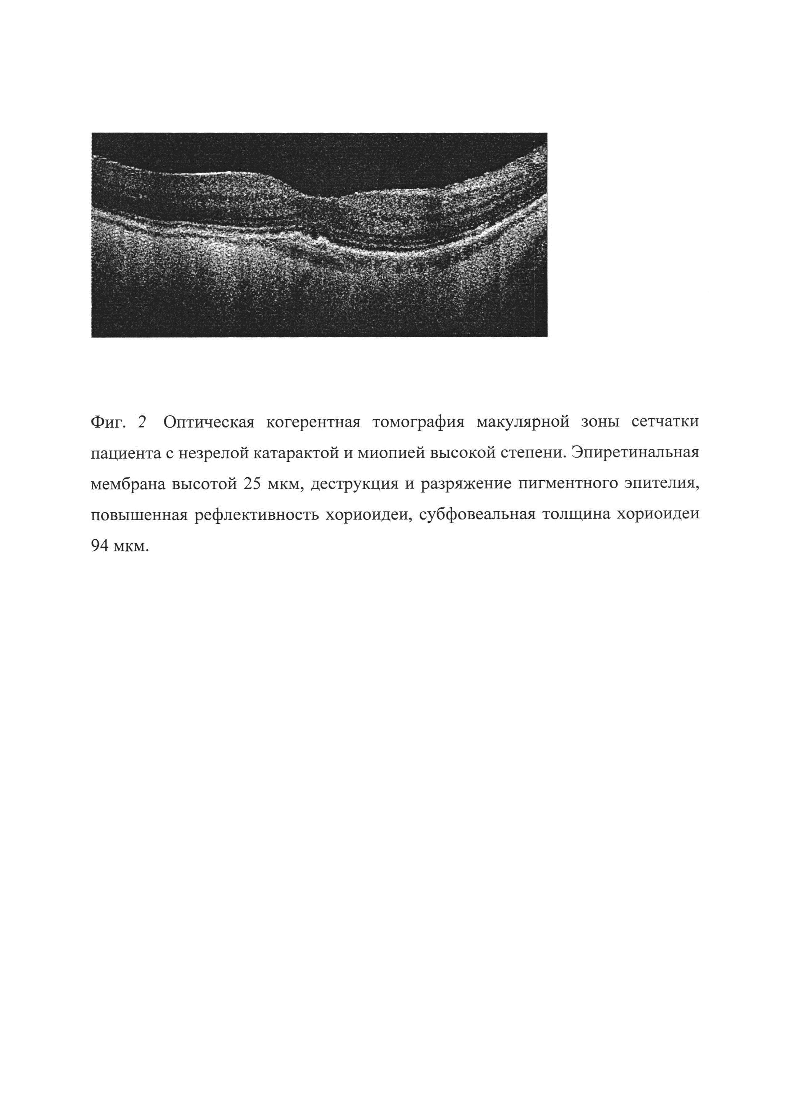 Способ прогнозирования остроты зрения после факоэмульсификации начальной и незрелой катаракты при миопии высокой степени