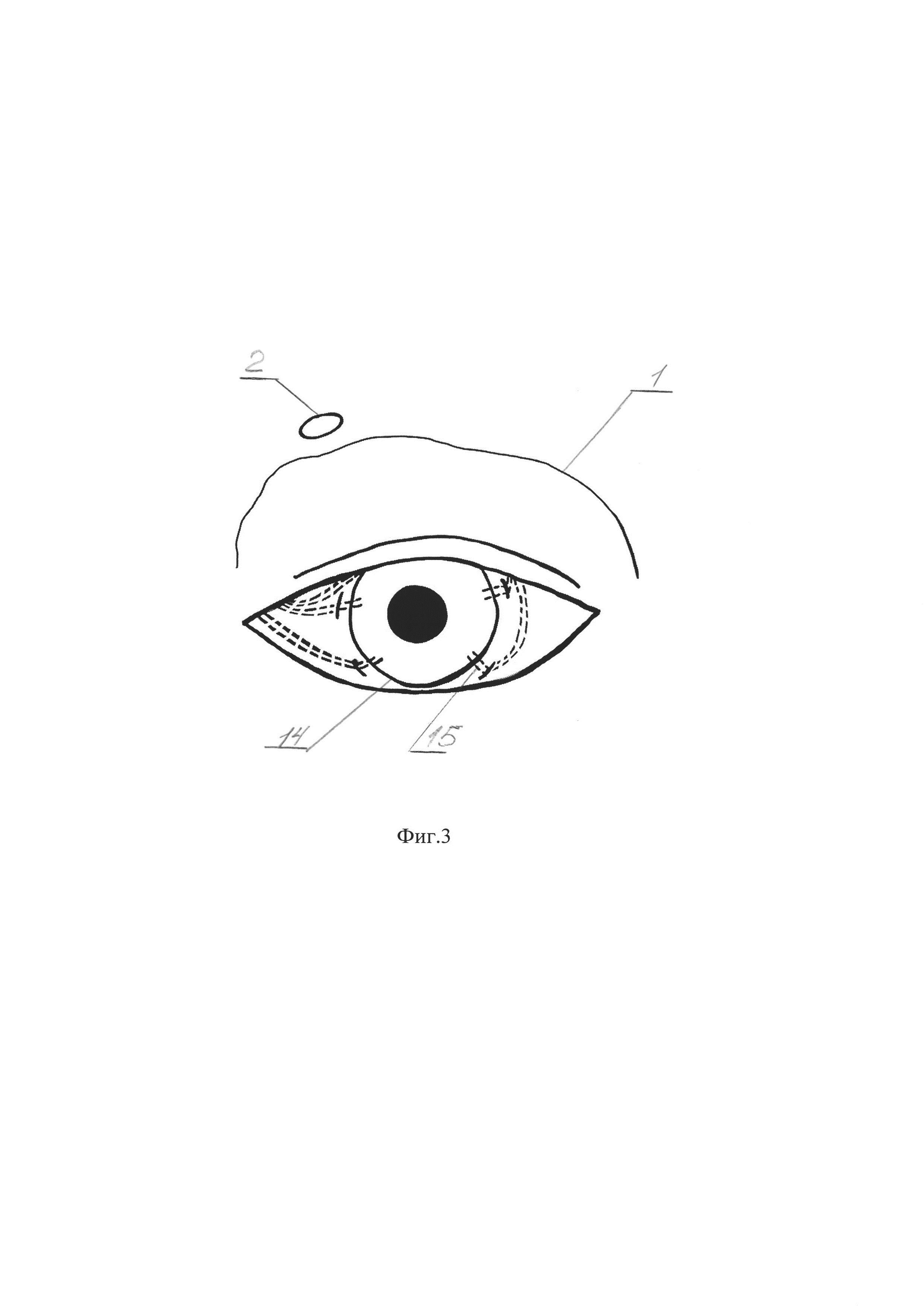 Способ восстановления трофики роговицы глаза при нейротрофической кератопатии