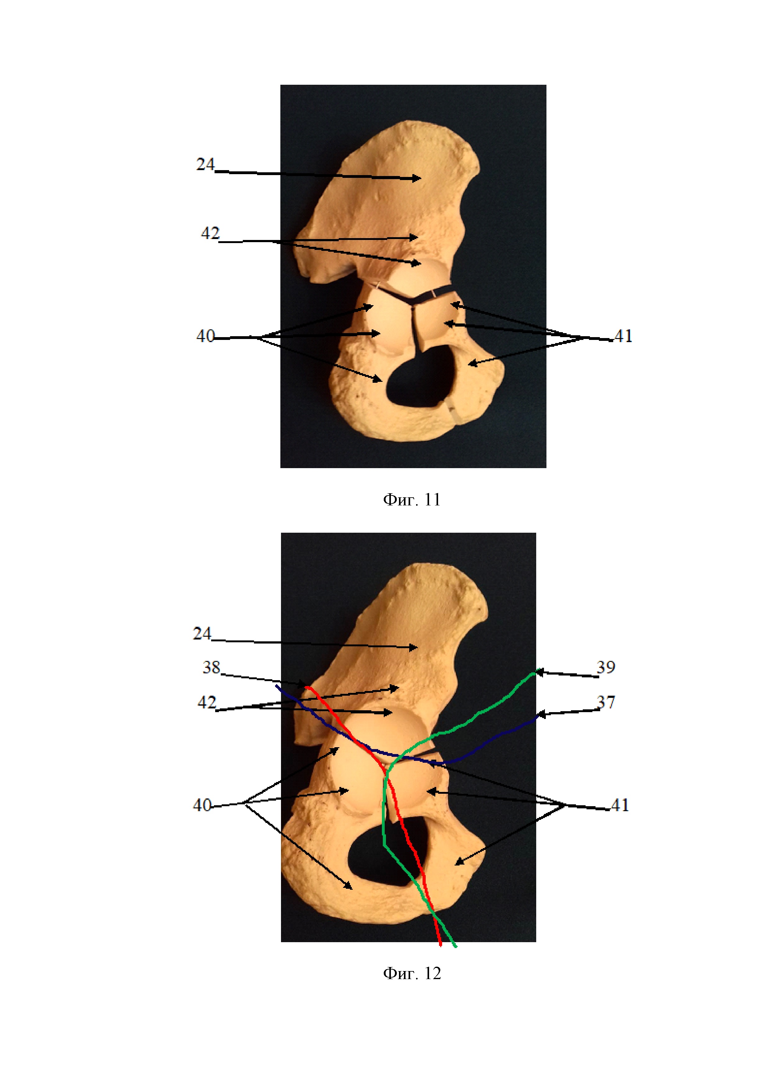 Репозиционно-фиксационное опорное кольцо для оперативного лечения смещенных полифрагментарных переломов вертлужной впадины