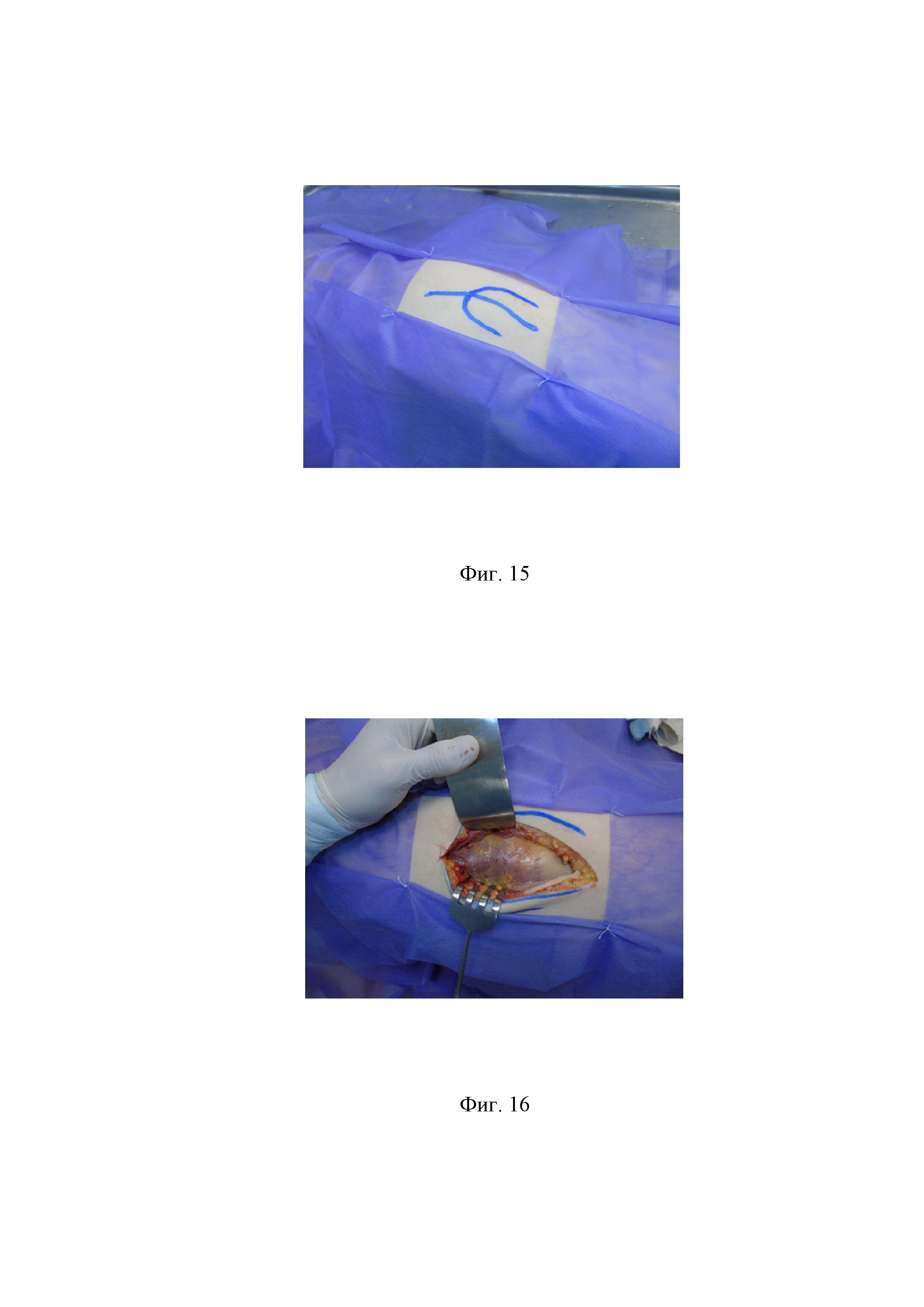 Репозиционно-фиксационное опорное кольцо для оперативного лечения смещенных полифрагментарных переломов вертлужной впадины