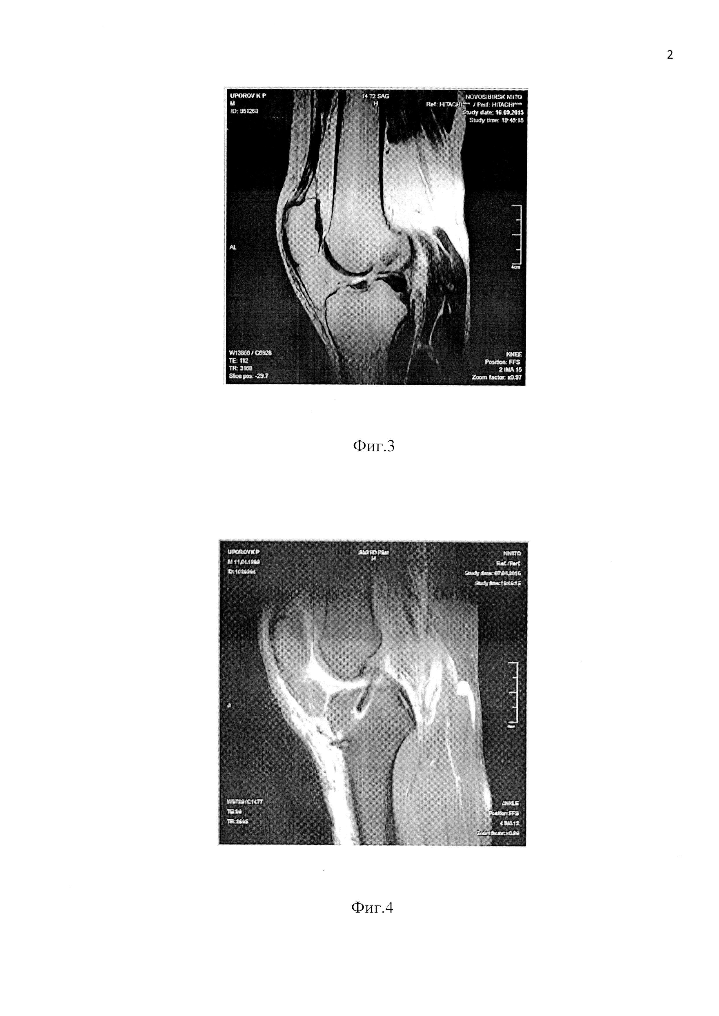 Способ двухпучковой реконструктивной пластики передней крестообразной связки коленного сустава у пациентов с фронтальной нестабильностью коленного сустава