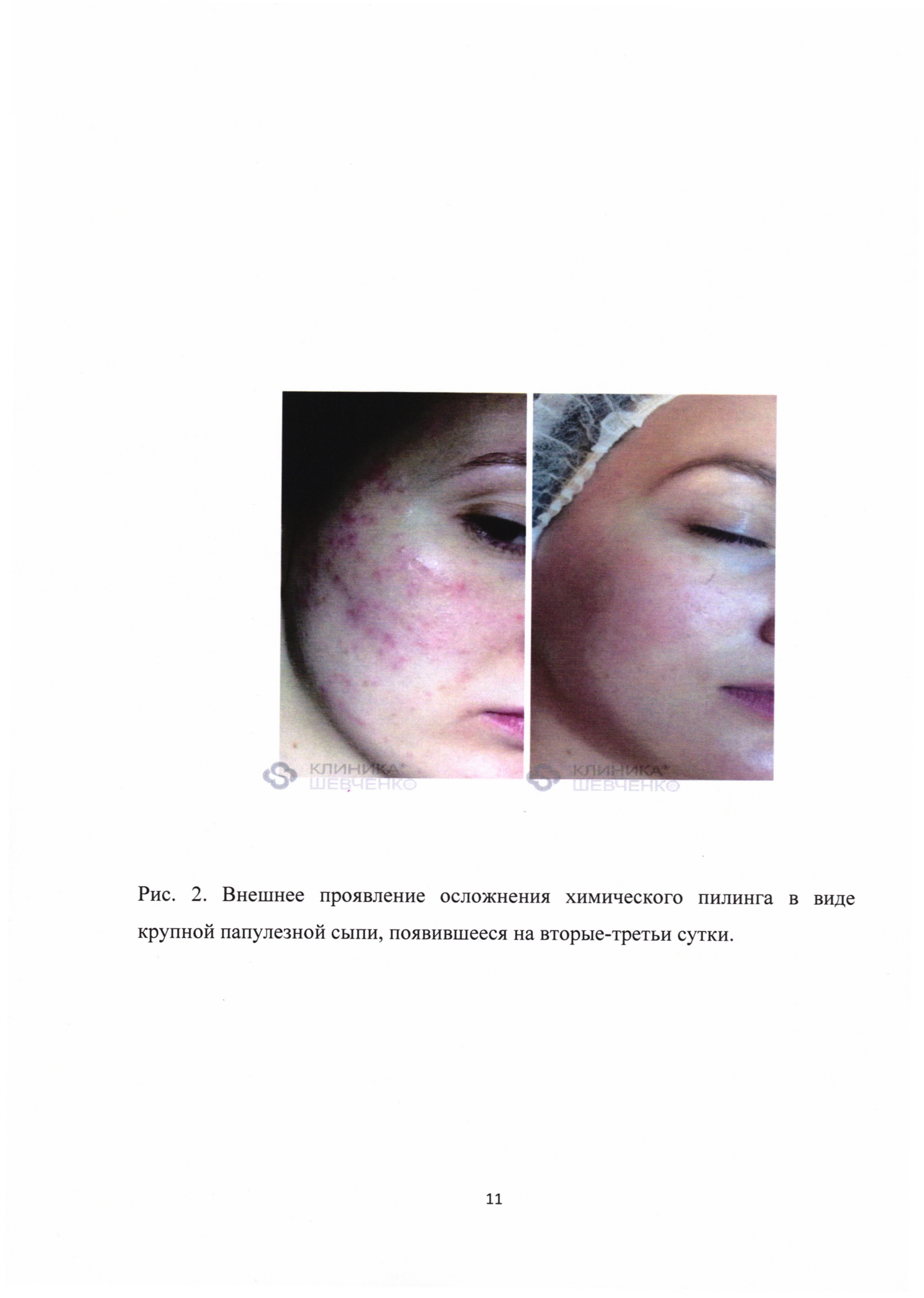 Способ профилактики реинфицирования травмированной поверхности кожи у пациентов при проведении косметической процедуры пилинга