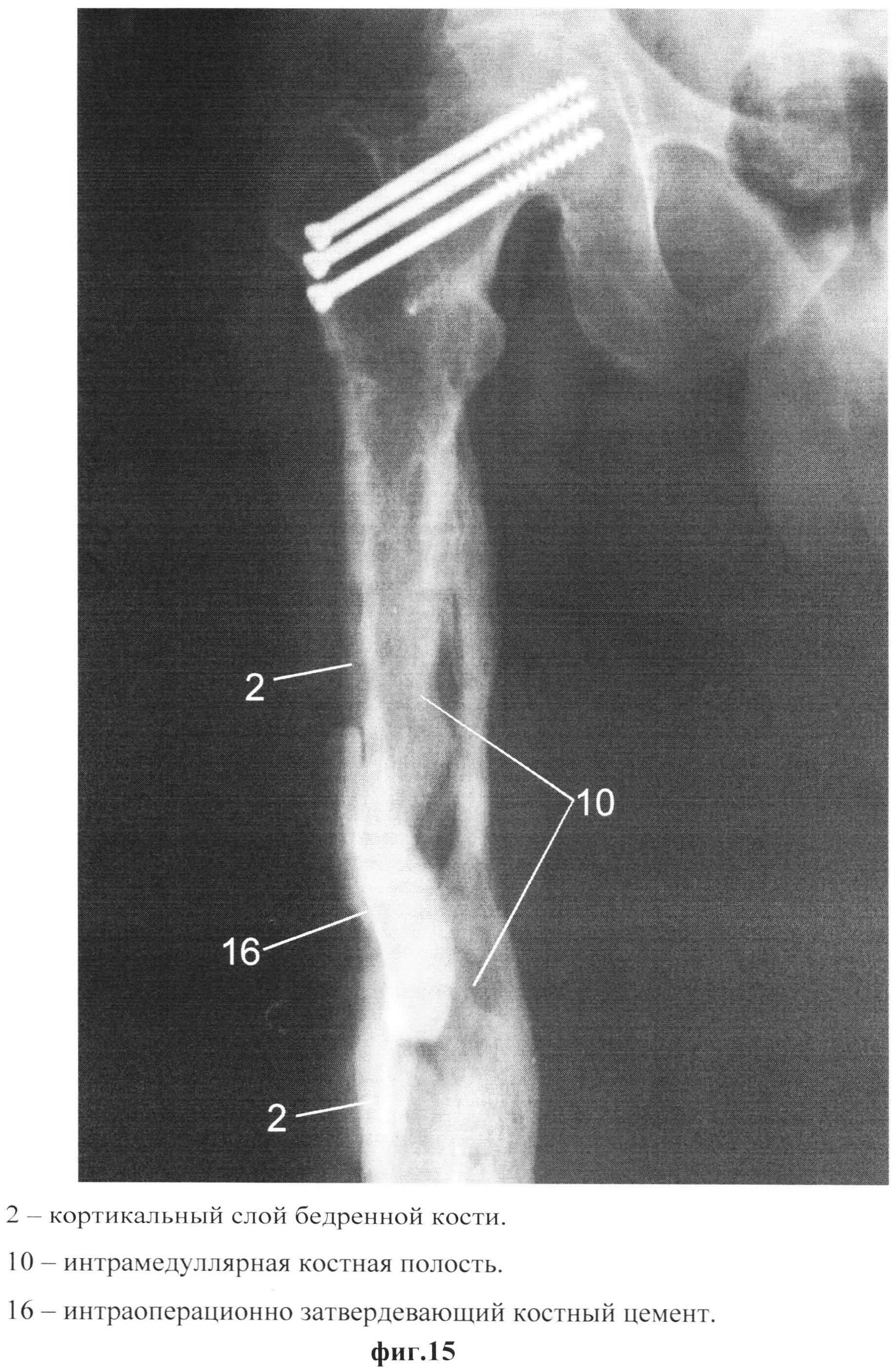 Практическое задание по теме Острый гематогенный остеомиелит нижней трети правой малоберцовой кости 