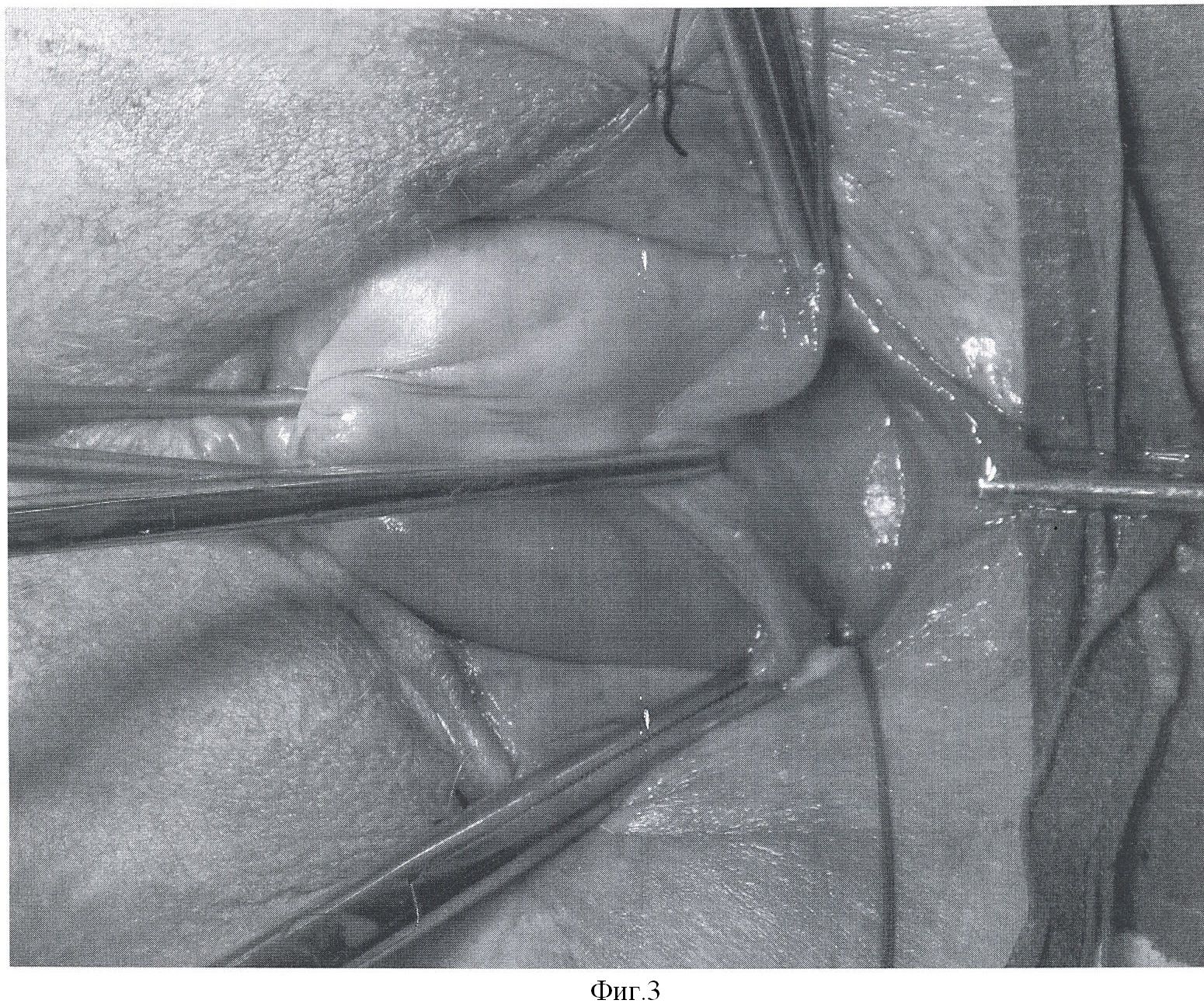 процедура по введению спермы в матку фото 52