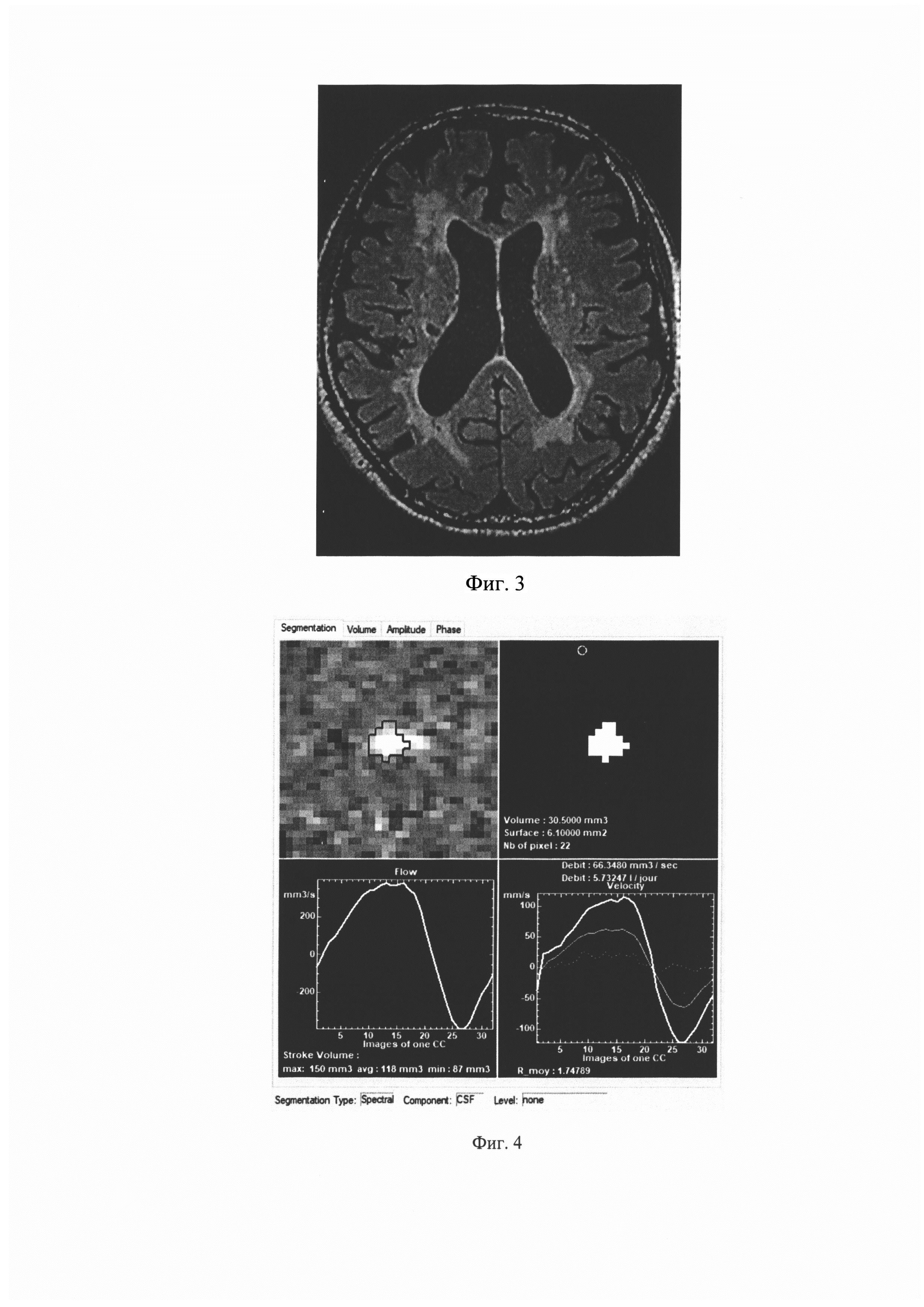 Способ оценки участия нарушенной ликвородинамики в развитии диффузного поражения белого вещества головного мозга при церебральной микроангиопатии